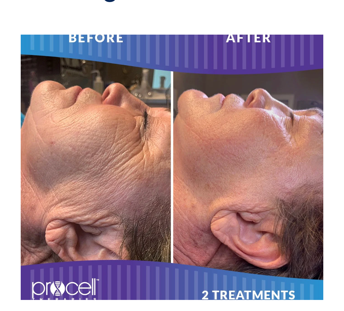 Why We Choose Microchanneling Over RF Microneedling—for Safer Collagen Stimulation