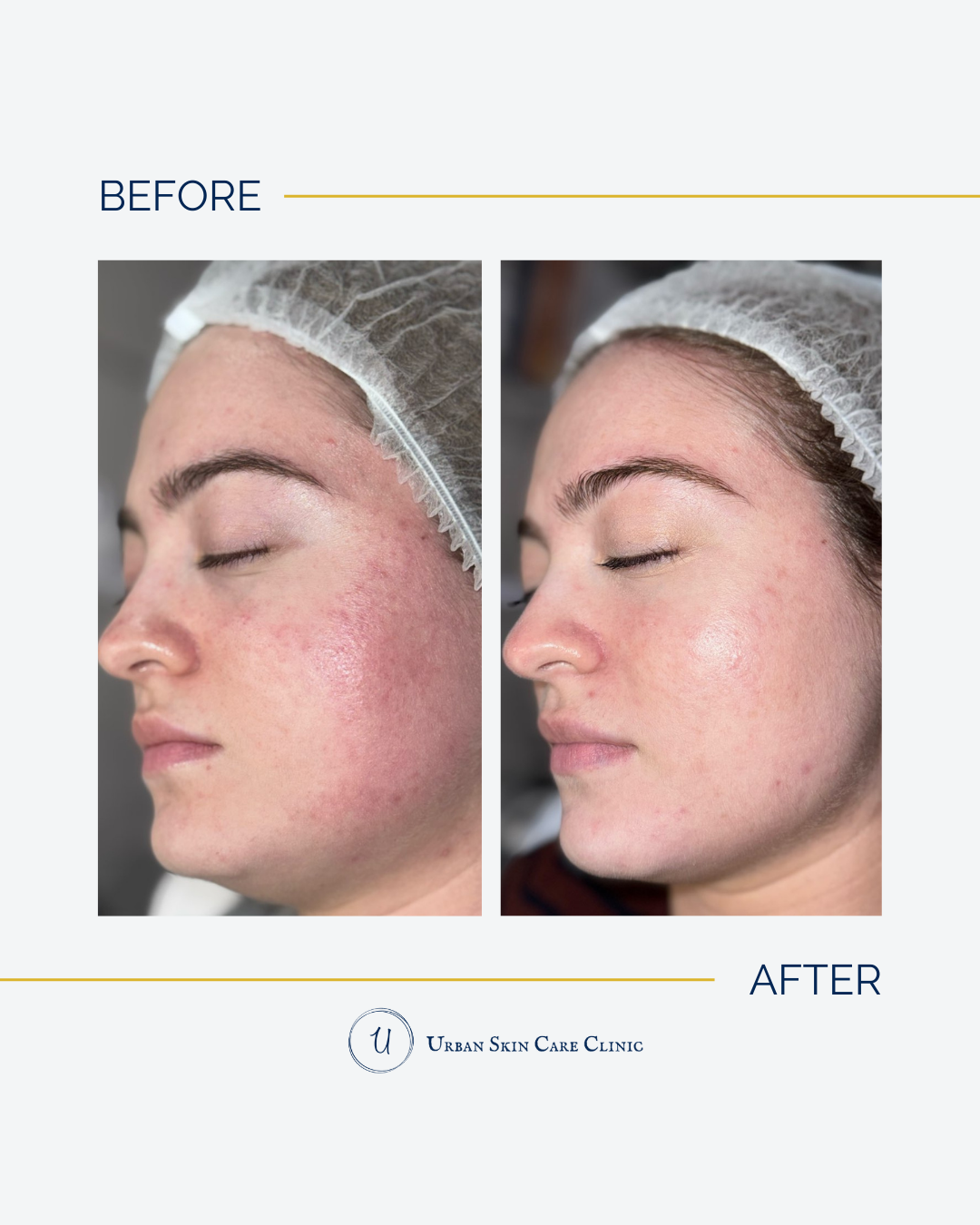 Tallow Skincare: Viral Trend vs. Acne-Safe Reality—What You Actually Need to Know