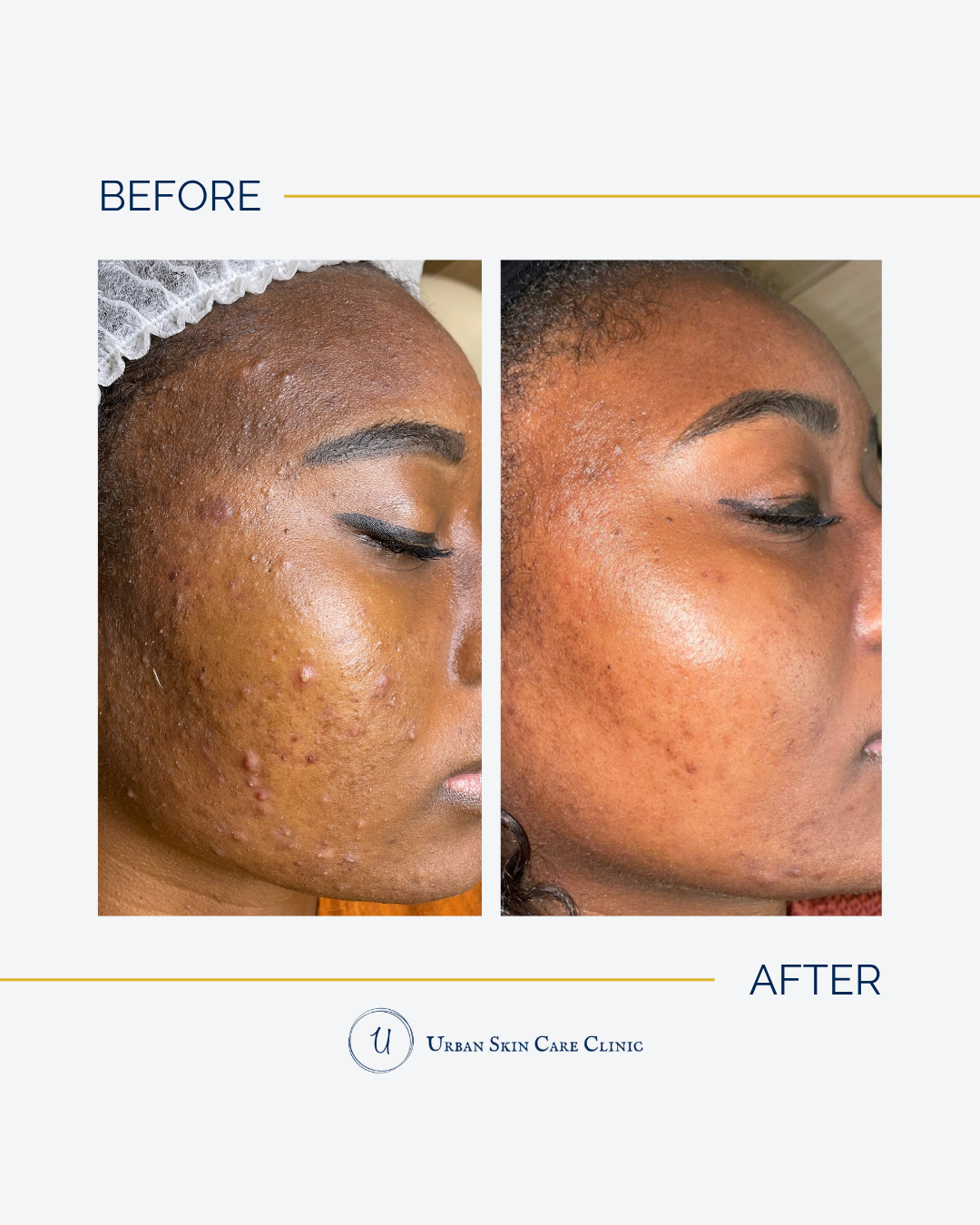 5 Everyday Habits That Are Making Your Acne Worse (A Roswell Esthetician Explains)