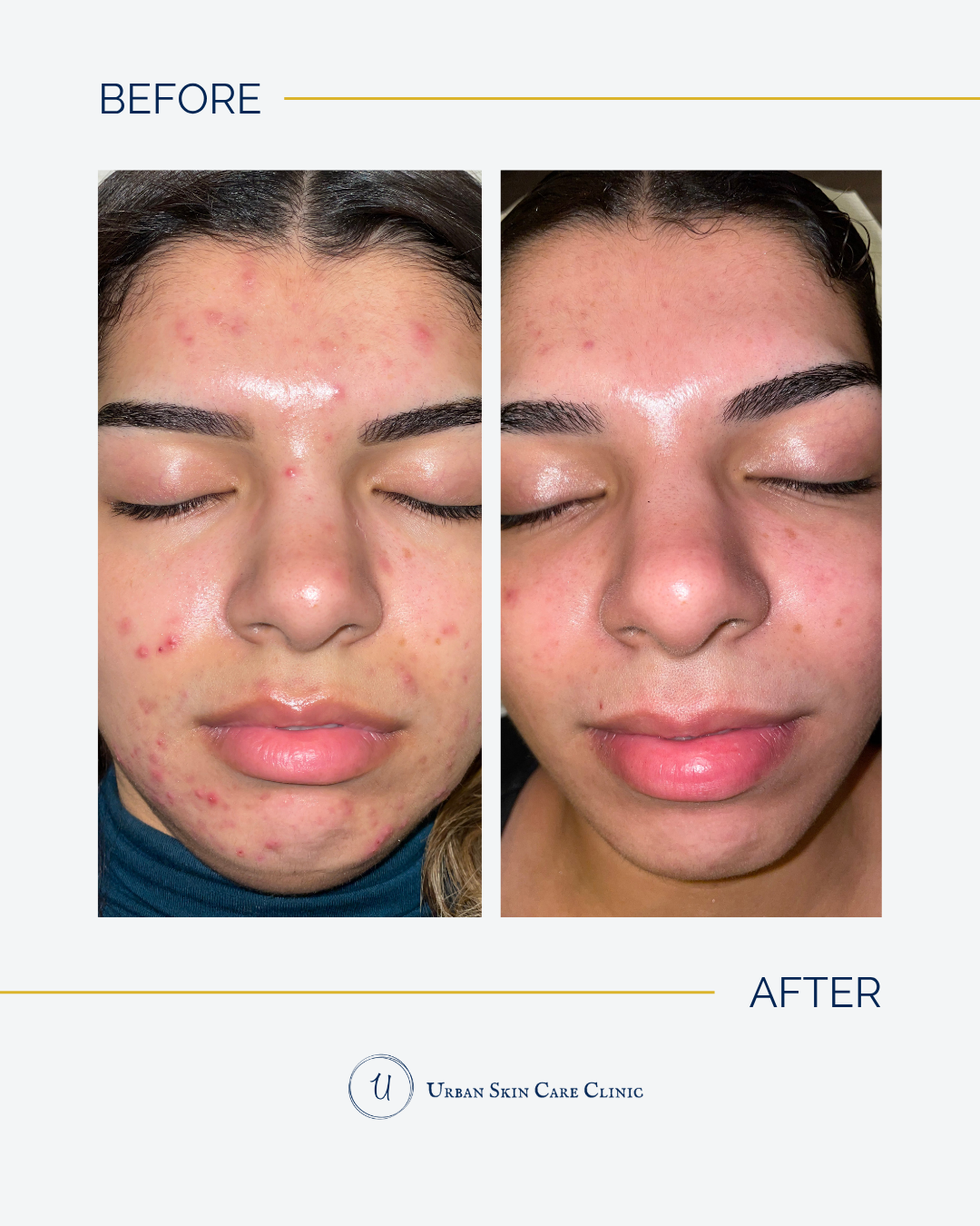 Teen Acne vs. Adult Acne: Why They're Different and How We Treat Both