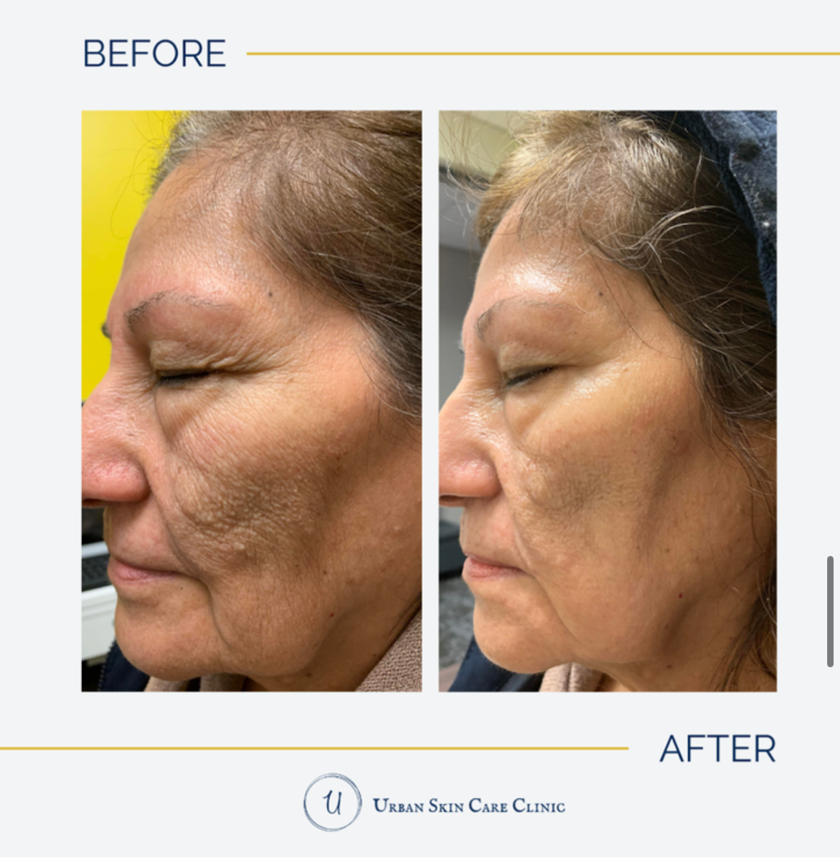 How to Age Gracefully Without Looking “Done” A Clinical Approach for Atlanta Women