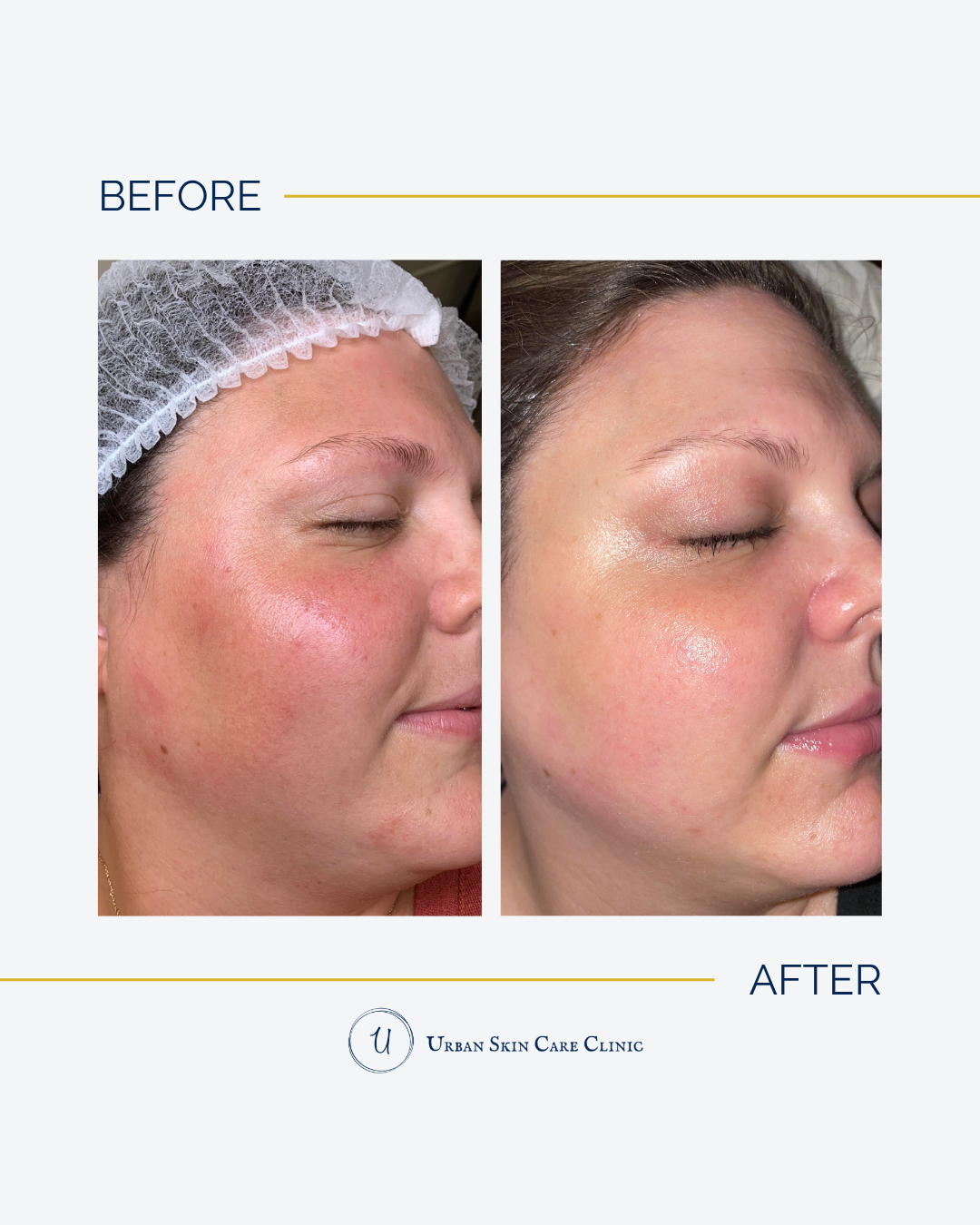 5 Homecare Mistakes That Are Stalling Your Skin Progress This Summer