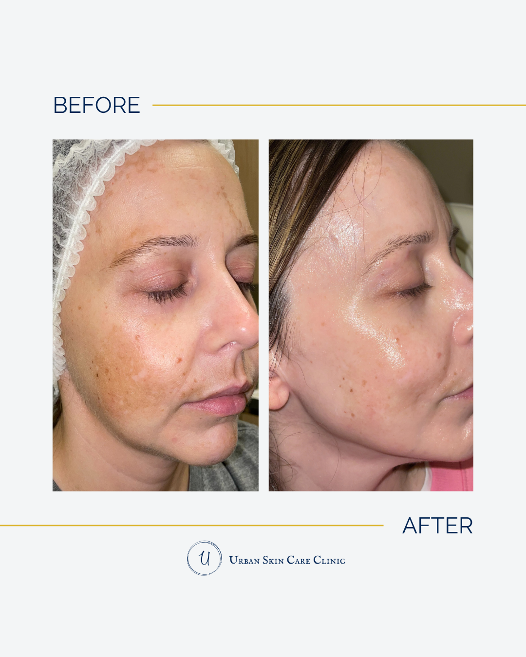 Why Summer Sun Is Making Your Dark Spots Worse (And What to Do About It)