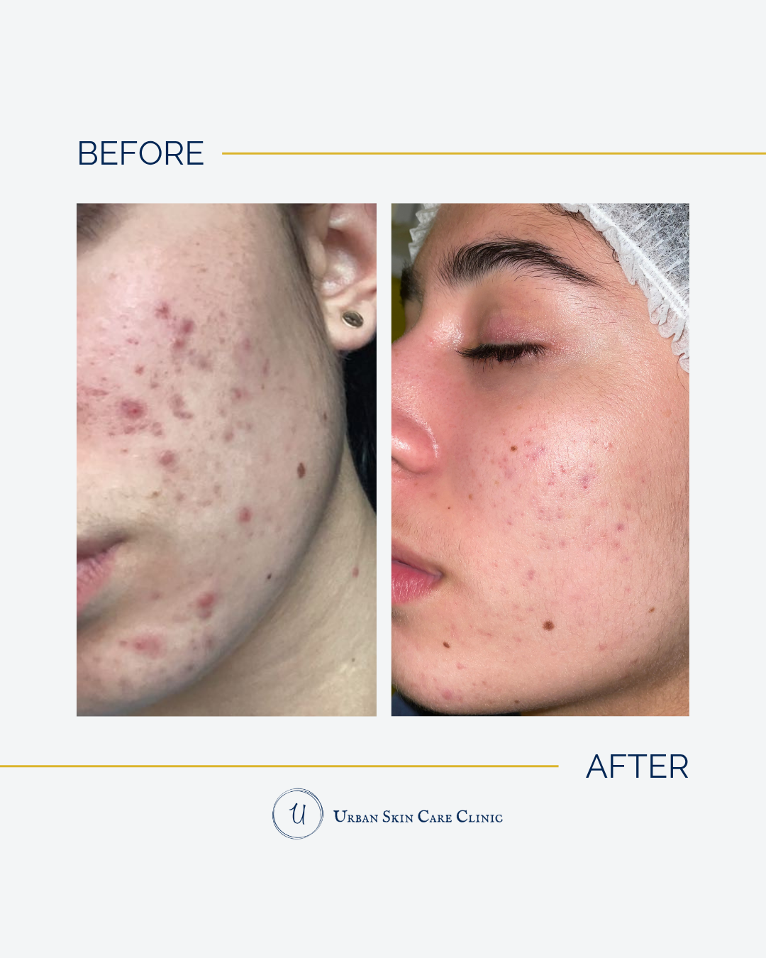 Why Am I Still Breaking Out in My 30s? The Adult Acne Truth