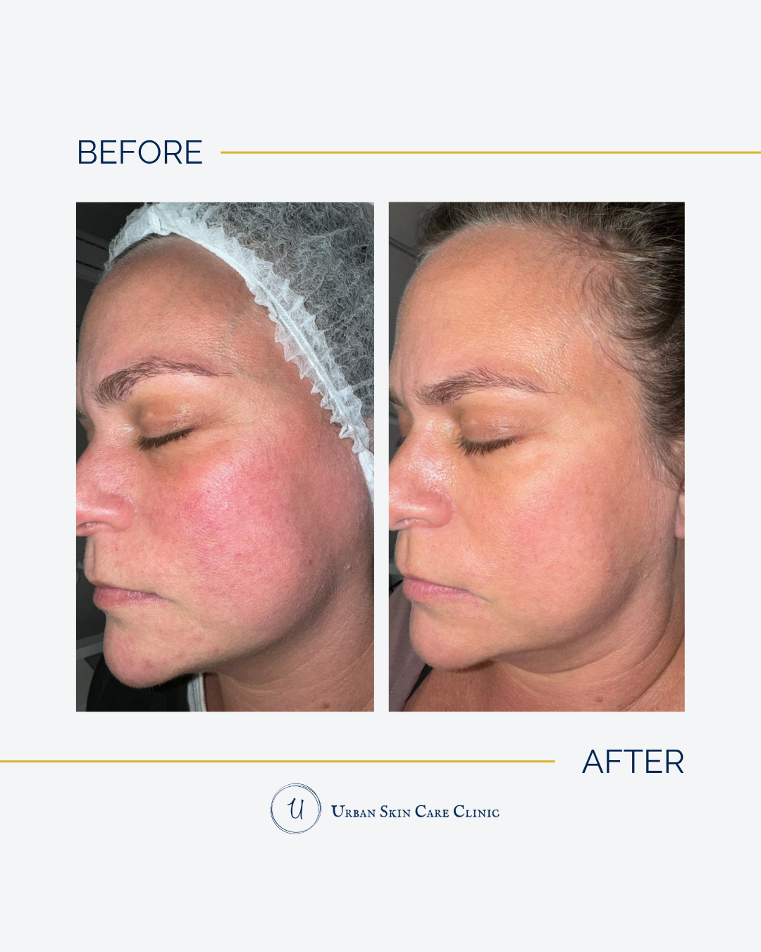 Before and after photos of acne clearing after 4 months of customized treatment at Urban Skin Care Clinic in Roswell, GA
