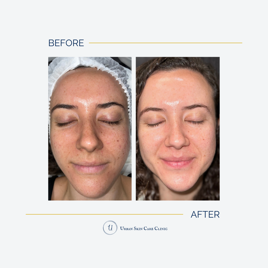 Aerolase Laser Near Me for Effective Facial Rejuvenation Aerolase Laser Near Me for Effective Facial Rejuvenation