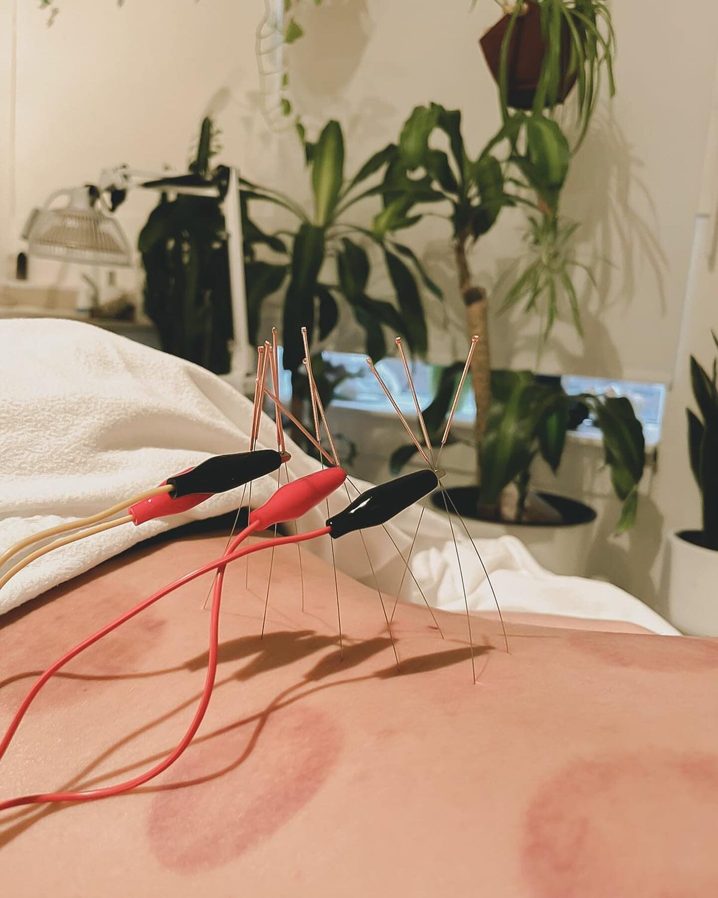 This perfusion treatment in the lower back vasodilates the blood vessels in the local area, pelvis, and the lower extremities, allowing more oxygen and nutrient flow the areas to heal tissues. In this case it is working wonders for chronic low back p