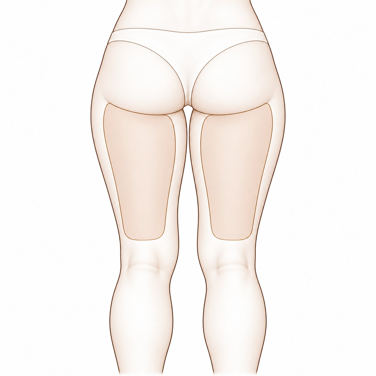VelaShape III - Thighs (Back)