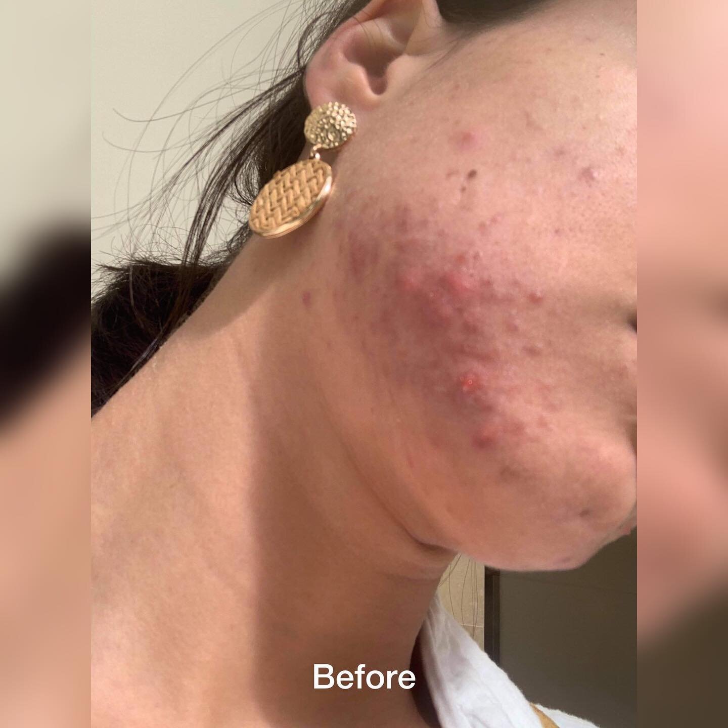 Before &amp; After results after 2 Days! 👉🏼

Swipe right to see this skin transformation!

My friend has super painful cystic acne around her jawline and chin and I knew I could help as I&rsquo;ve been in her shoes before. 

This was the result aft