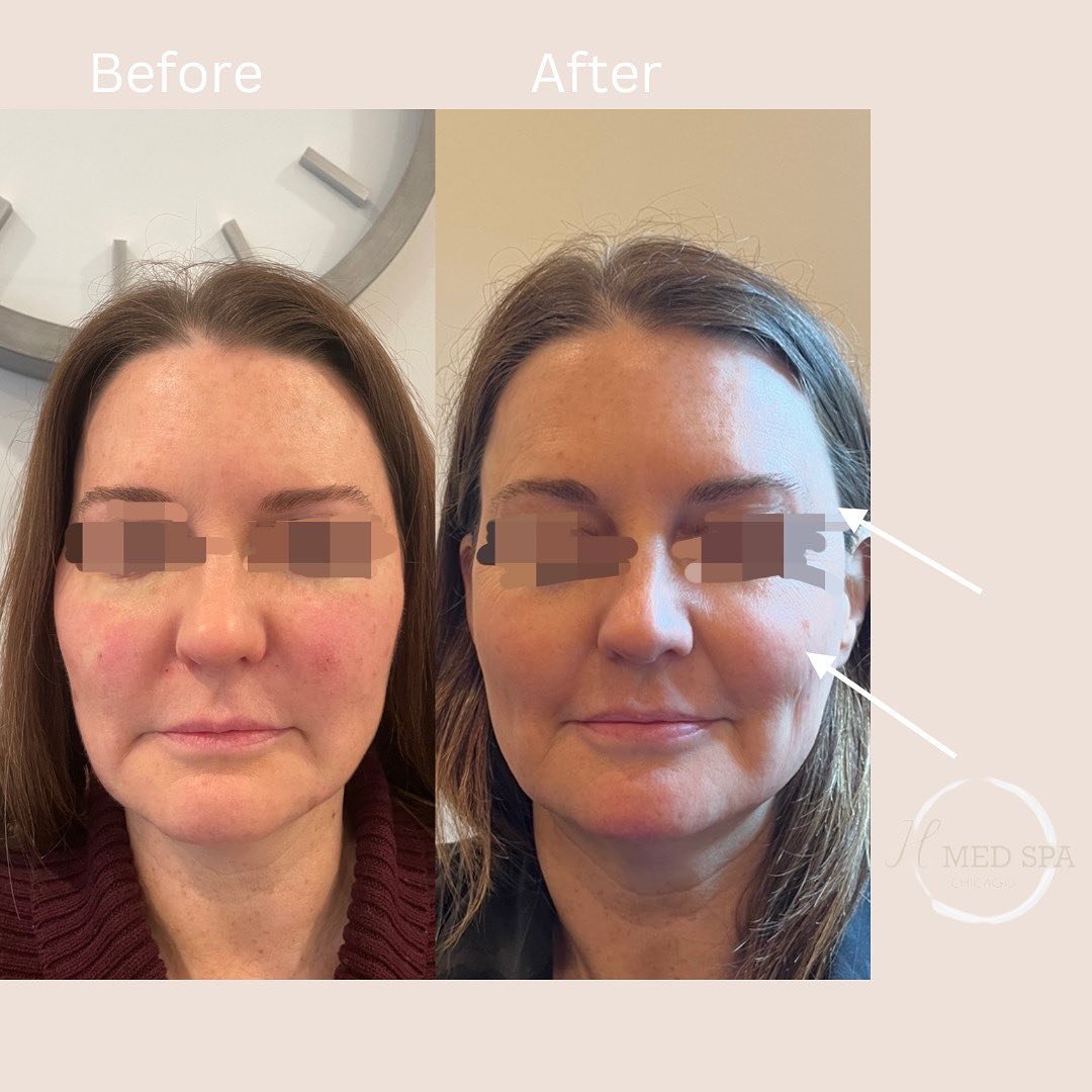 💫 Experience this dynamic duo of Morpheus8 and Sculptra. This was after one session! 3 sessions are recommended for maximum results! 

✨ The facial texture improves with plumper, smoother and less wrinkle by the natural way that it stimulates your o