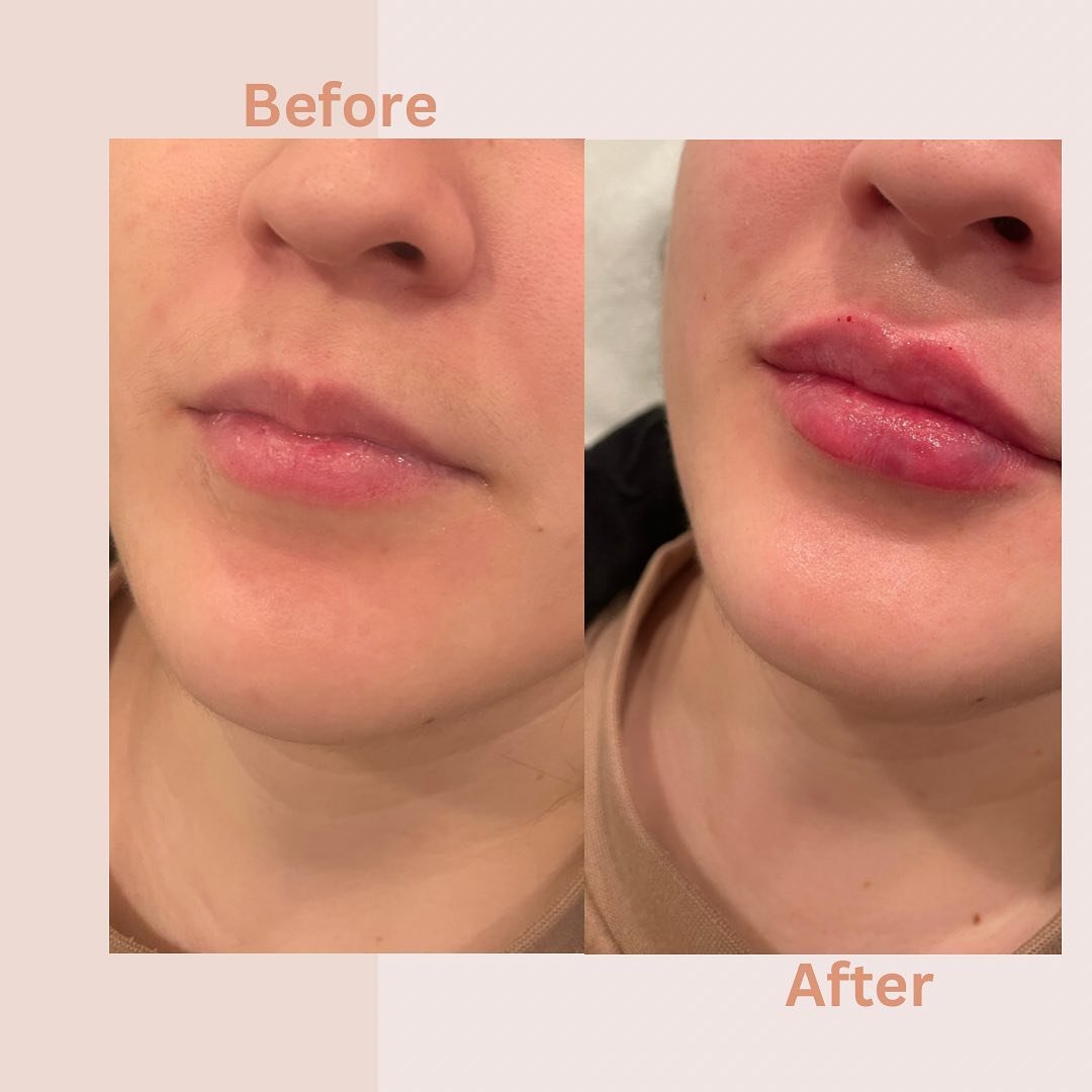 💉 Lip filler before and after! 

📱 us at 7736978316 to set up your first consultation with us! 

#lipfiller #lipbeauty #beforeandafter #juvederm #restylane #versa #Lipenhancement #beauty #plumplips #Medspachicago #Medspawickerpark #aesthetic