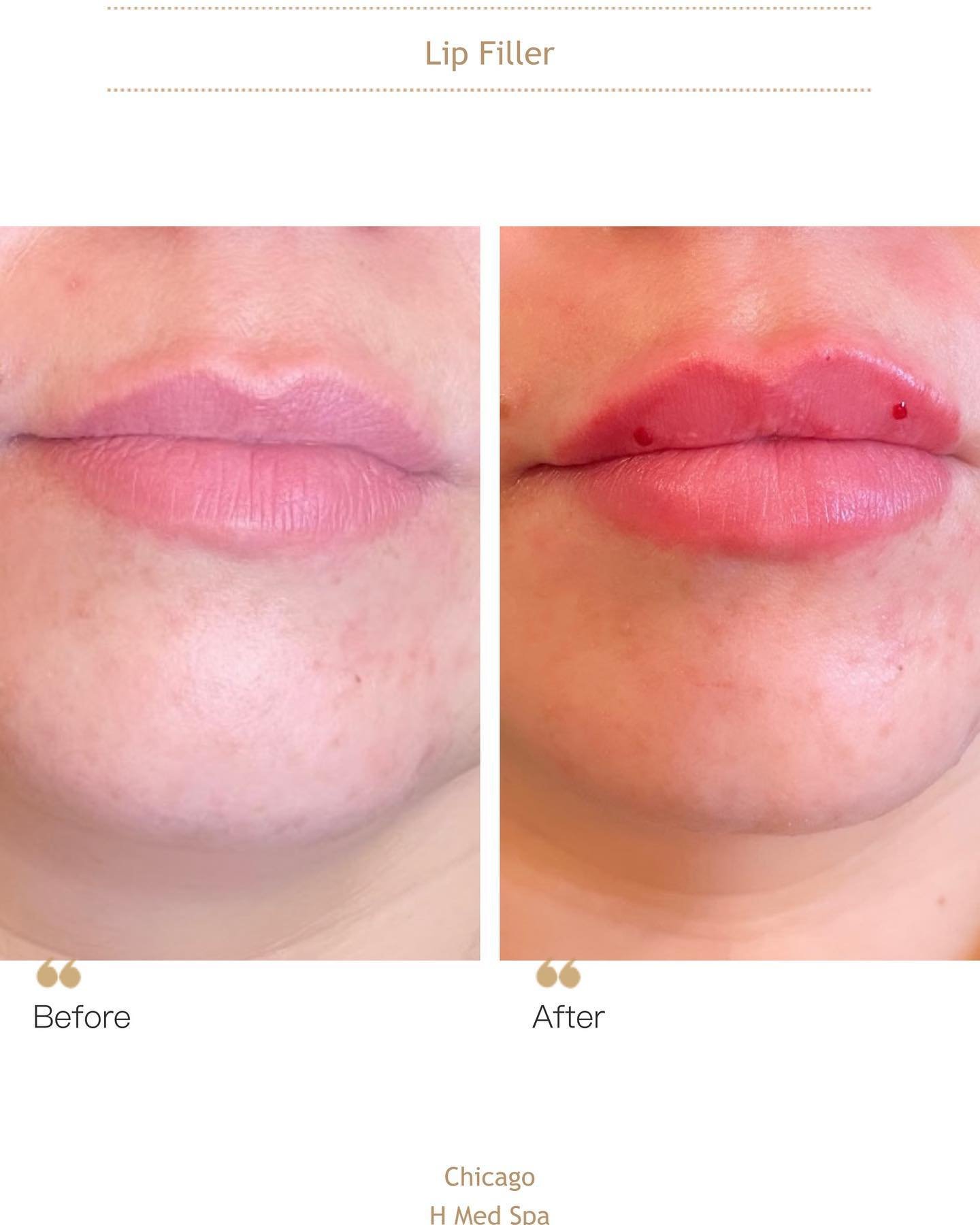 Beautiful Lip Enhancement 👄 
This hyaluronic acid lip filler will help to add volume if you have thin lip, we can also help you to design any shapes you like according each own individual. Usually it takes about one-two weeks to settle with more nat