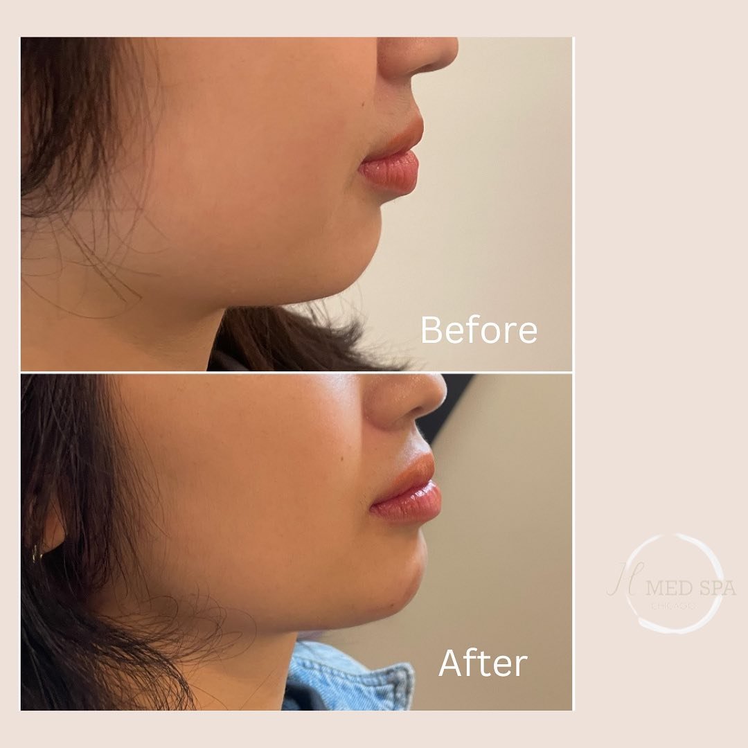 Chin Filler 💉💫

If you are considering to get chin filler done, we&rsquo;d be happy to help you set up a consultation with our expert injector Dr. Alkadri to discuss how we can help you to achieve a better and natural change. 

☎️ us at 7736978316 