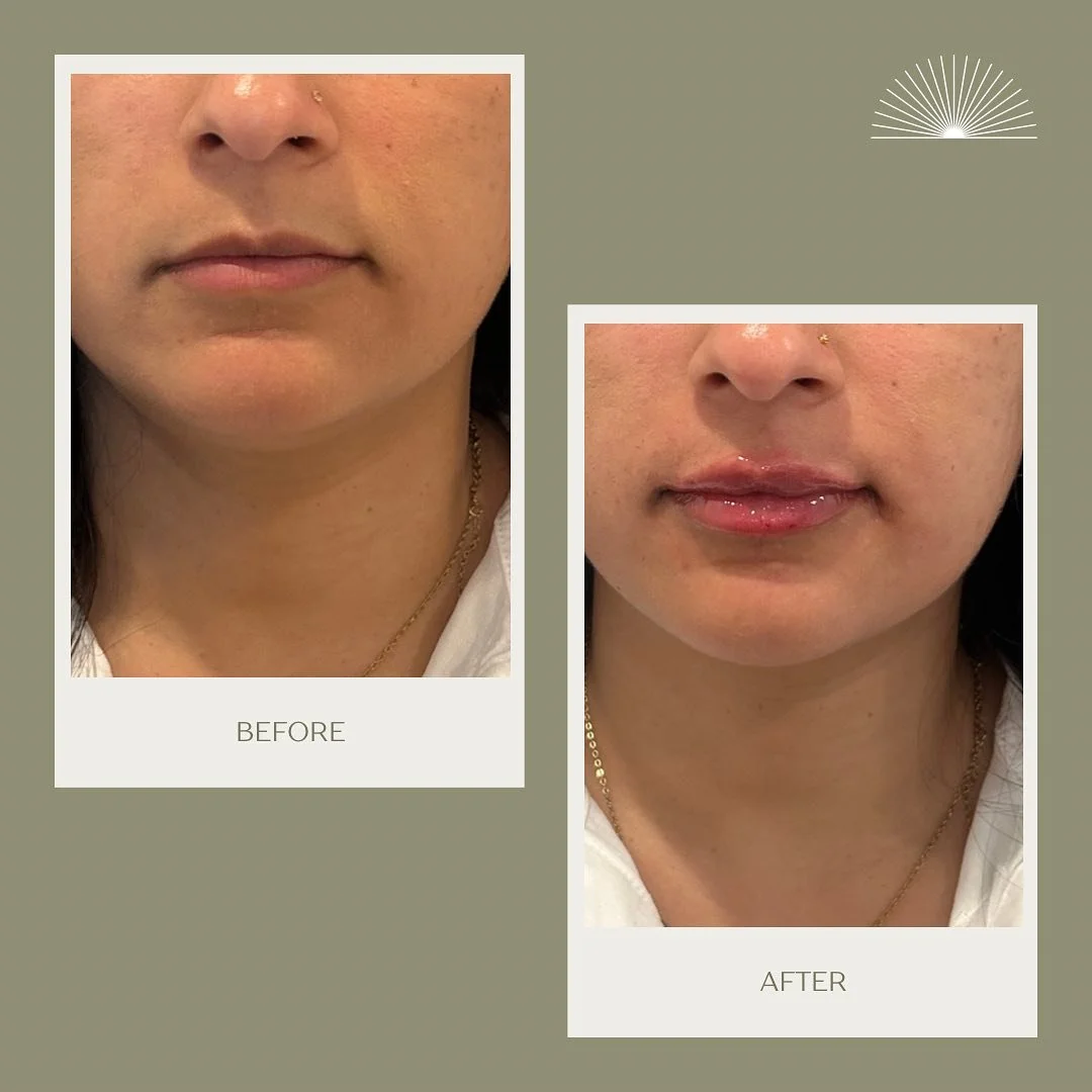 Obsessed with the lips💋 summer time refreshment ☀️🌸 Lip Filler 🧡

#LipFiller #summerlips #gorgeouslips #BeforeandAfter #summertimefun #chicagomedspa #hmedspa #botox #fillers