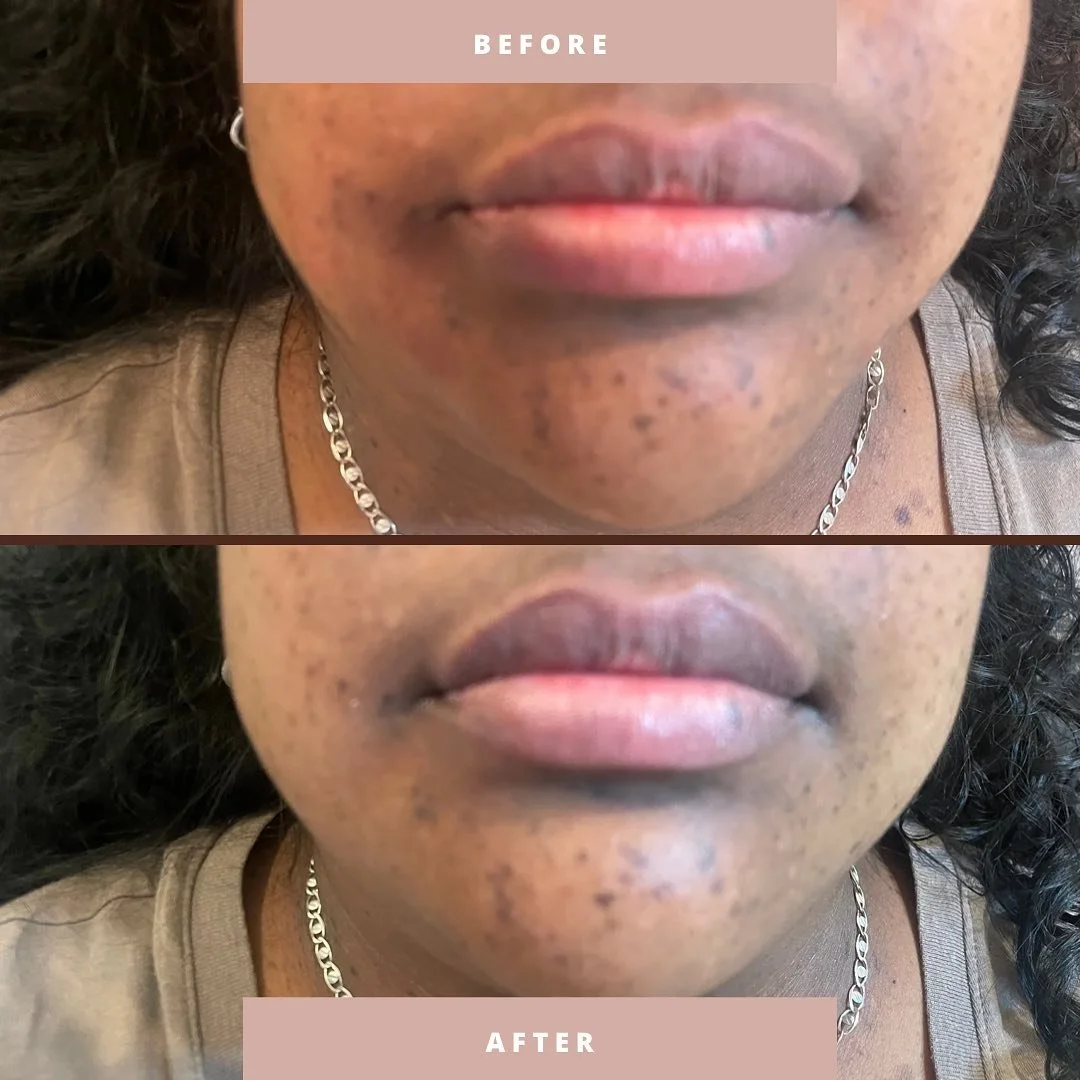 Lip filler before and after 💋💉 only half syringe, but subtle look ✨🧬 Please allow up to two weeks for full results! 

Call us to book your appointment today 💕 

#lipfiller #beforeandafterphoto #juvederm #juverdermlips #filler #botox #hmedspa #med