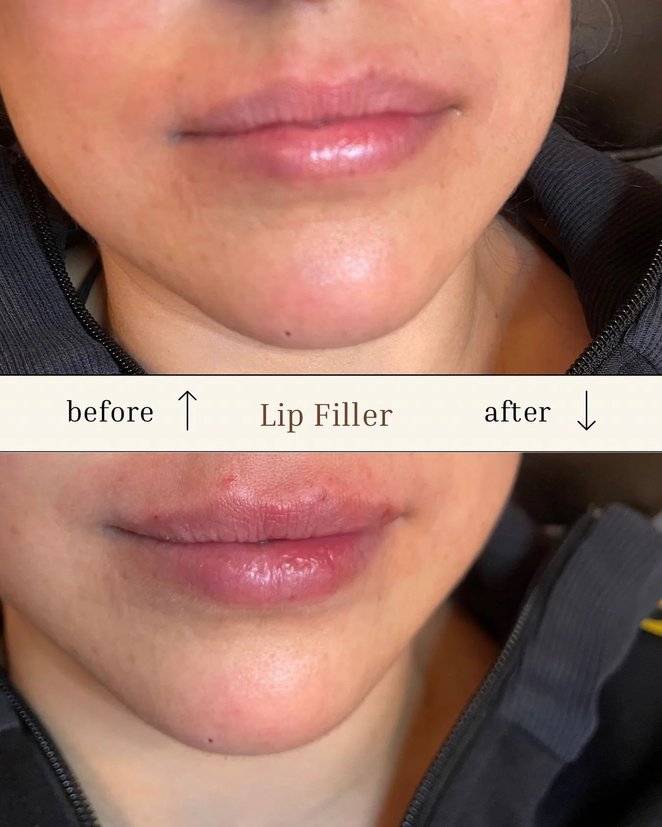 Just a tiny amount of lip filler with an amazing result ✨🫶 

Call to book your appointment today! (773) 697-8316 

#LipFiller #lookbetter #feelingamazing #SelfCare #fillers #Medspa #wickerparkchicago #lipfillerchicago