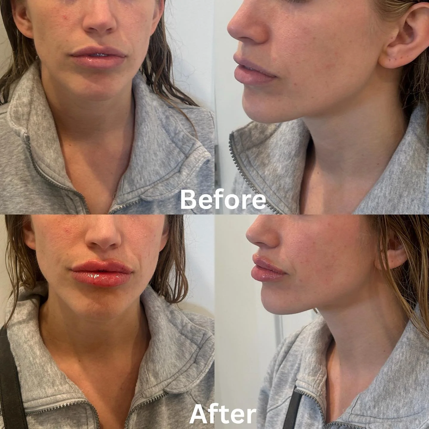 Favorite treatment in All seasons🤩 Lip Enhancement 💉🧡 
☎️ us at (773) 697-8316 to schedule an appointment! 
#lipfiller #LipEnhancement #Medspa #medspachicago #selfcare #lipfillerchicago #medspawickerpark #beforeandafter