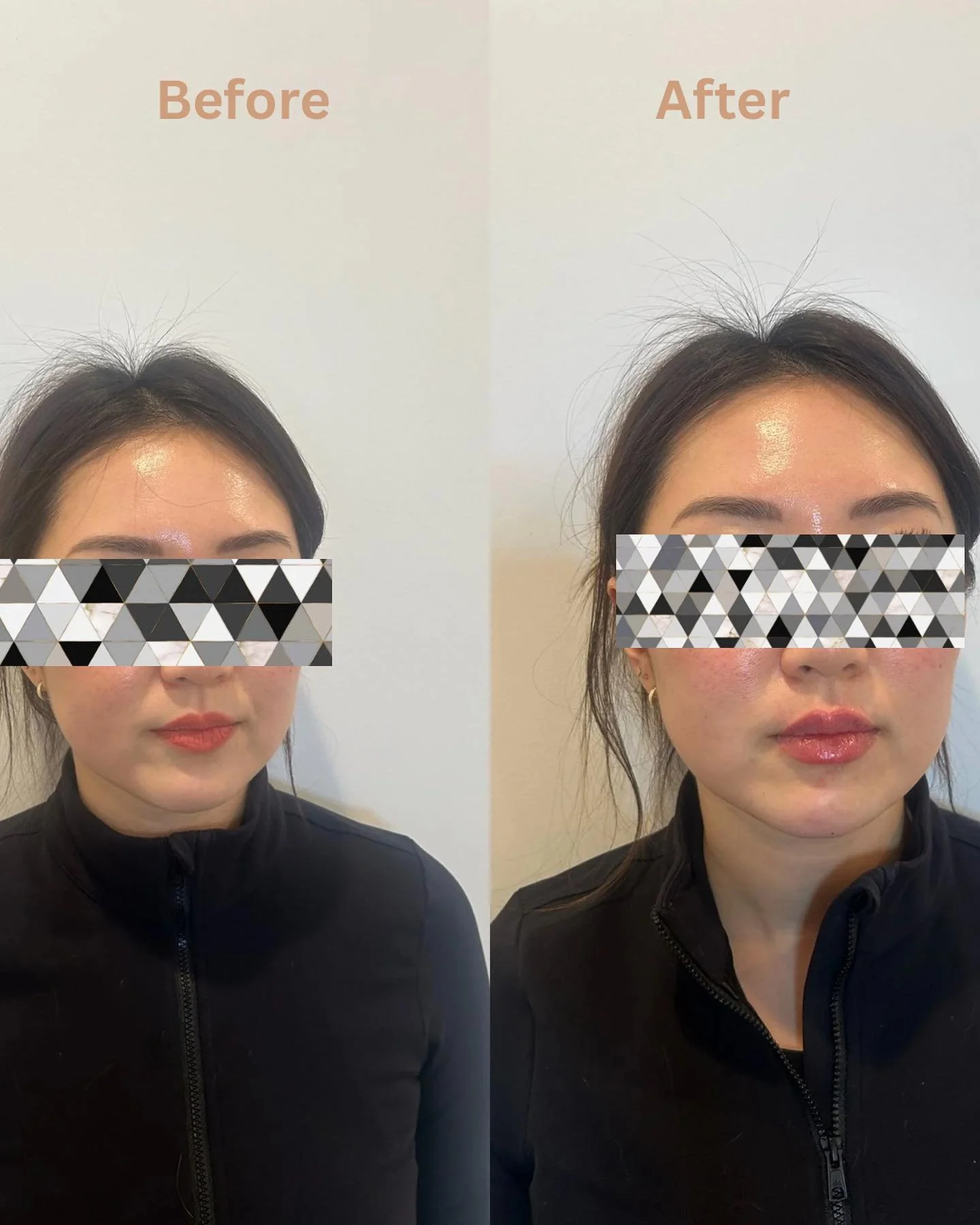 Just a little bit of cheek and lip fillers 💉 Stunning 🤩 

☎️ us at (773) 697-8316 to schedule an appointment 🧡 

#beforeandafter #gorgeous #lipfiller #cheekfiller #fillers #botox #medspachicago #lipfillerchicago #medspawickerpark #nurseinjector #n