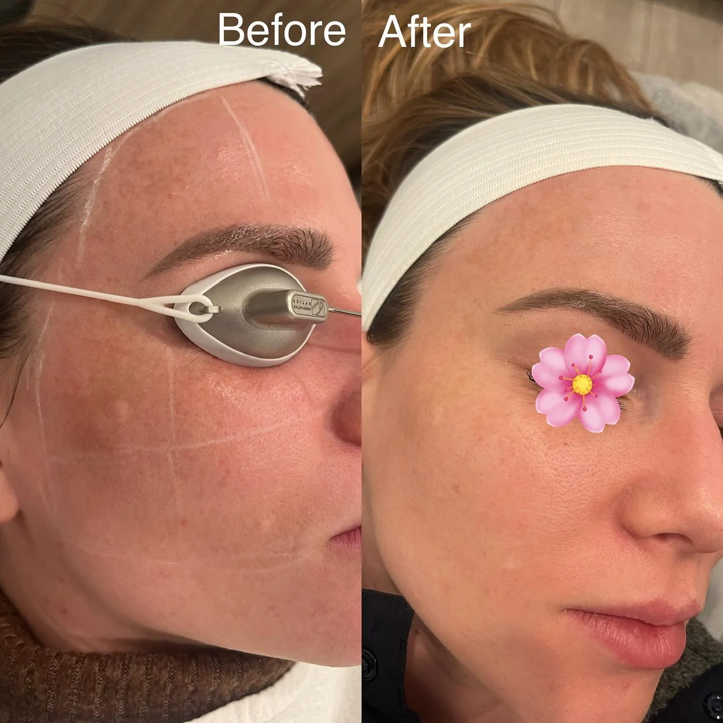 Laser pigmentation. This was after 3 sessions before and after photos 🙌 

If you&rsquo;re struggling with pigmentation, brown spots or sun spots. Treat it this winter. Call us for more information! 

#brownspotsremoval #lasertreatment #pigmentation 