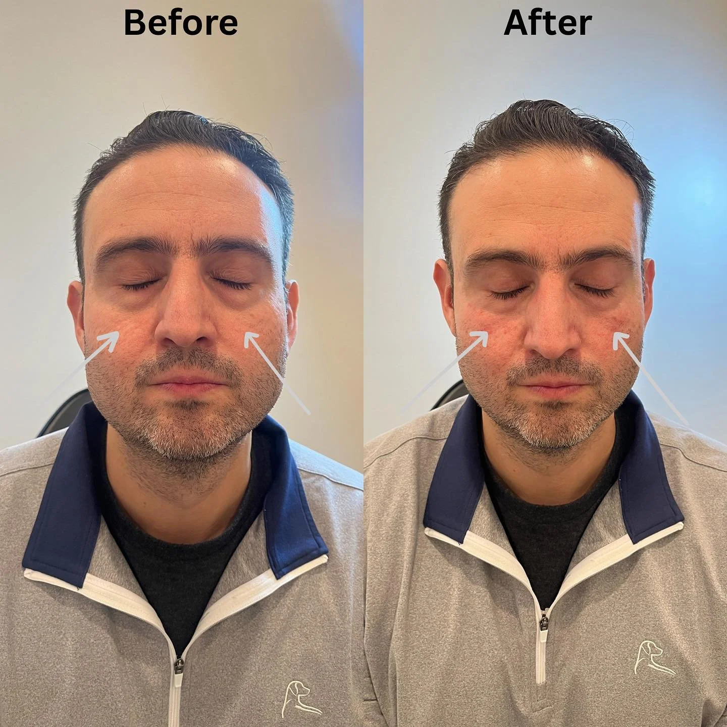 Under eye filler 1 syringe used💉 This right after photo still have bit mild swelling, usually it can take up to 48 hours with more subtle, and smooth look ✨ under eye filler helps to restore lost volume, smooth hallows with refreshed and radiant loo