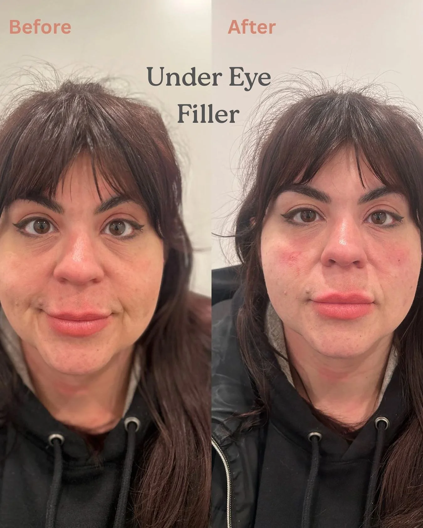 Under eye filler ✨ quick and immediate results. 

☎️ us if you&rsquo;d like to schedule an appointment! 

#undereyefiller #fillerschicago #md #mdinjector #medspachicago #botoxchicago #hmedspa #selfimprovement #holidays2025