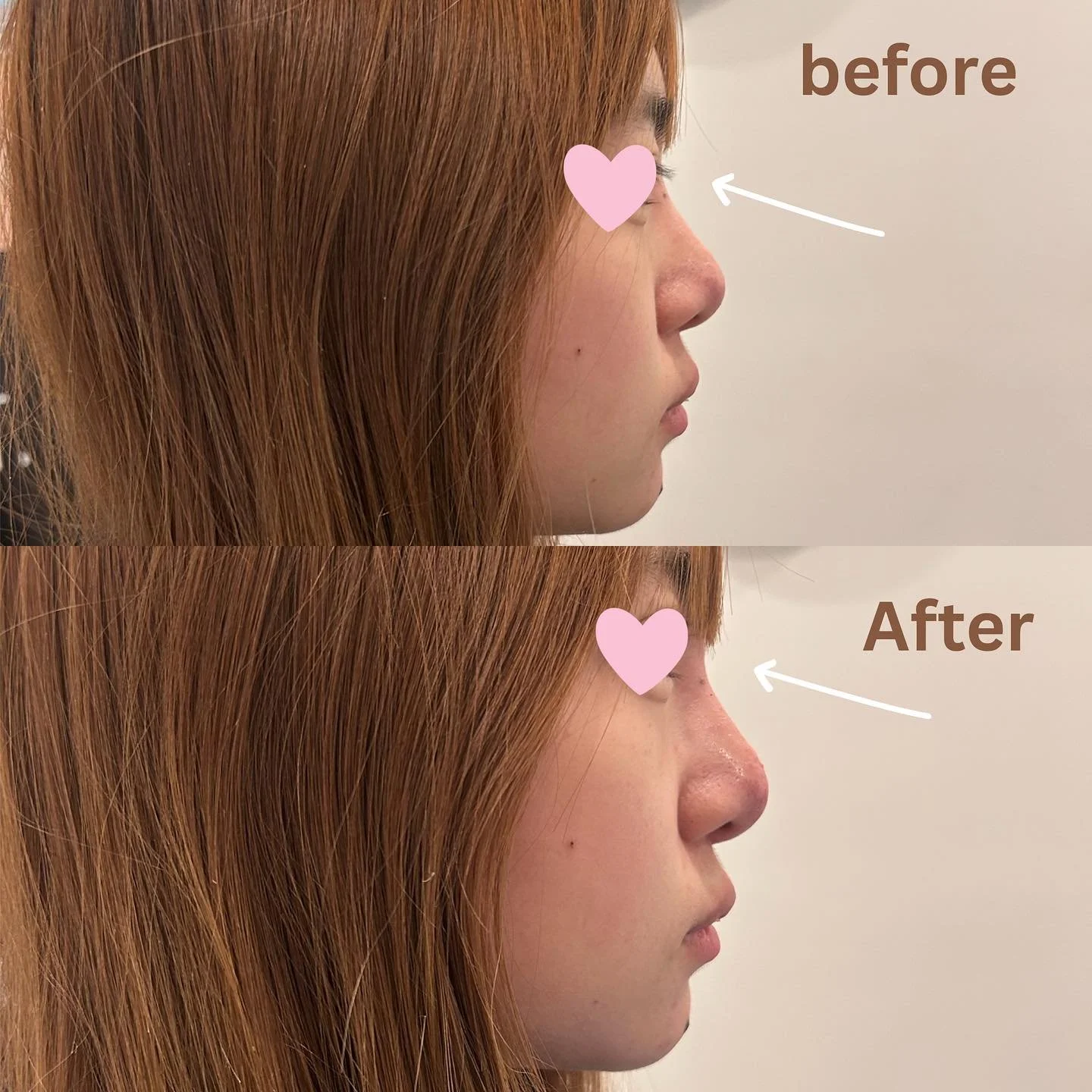 Nose filler 👃 small touch big difference 🤍 
Hyaluronic acid 1 syringe 💉 used. It helped bring more structure, symmetry and natural look. 

Call us to schedule a consultation! ☎️

#nosefiller #filler #nosefillerchicago #beforeandafter #naturallook 