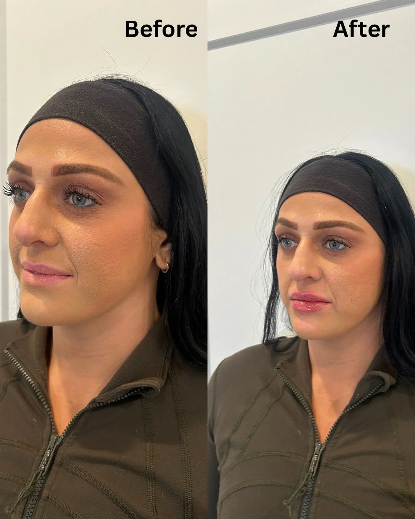 Step into 2026 with your favorite treatment. 🤍
Lip filler with less than 1 syringe touch up. 💉 please allow up to 7 days for a fuller and natural result with less swelling. 

Call us if you&rsquo;d like to schedule an appointment ☎️ 

#lipfiller #f