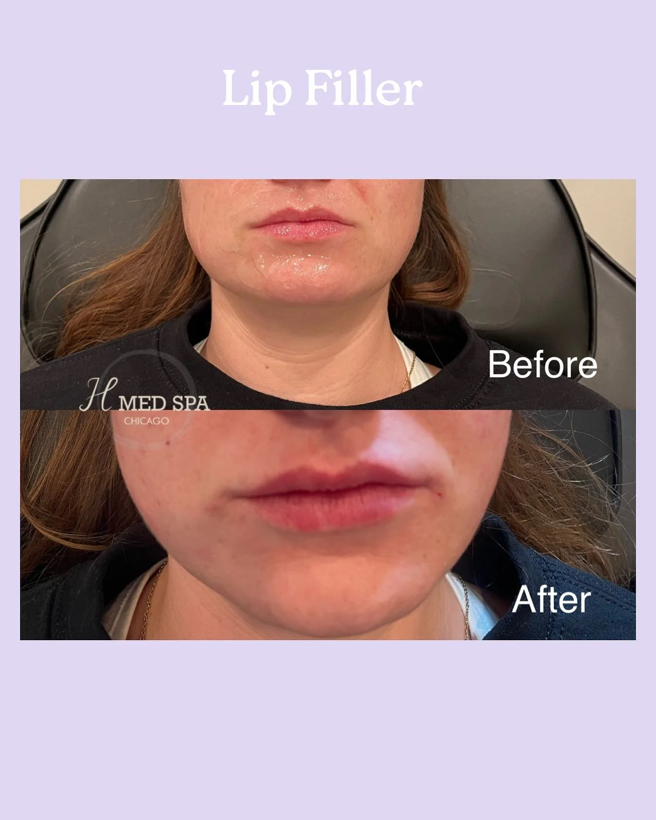 Lip filler touch up 👄 obsessed with the subtle, and natural results. ✨ Lip filler helps with more structured and defined look 🤍 show the best of you. 

#lipfillerchicago #lipfiller #beforeandafterphoto #medspachicago #injector #selfconfidence #look