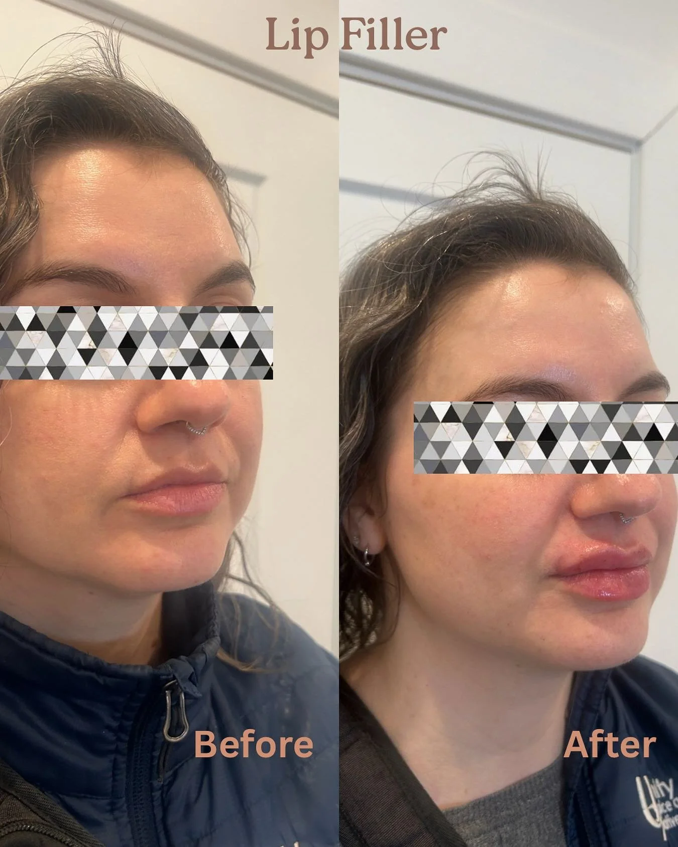 Lip filler refresh 👄 stunning. Please allow up to 2 weeks for full and subtle look. Swelling usually go down within days. Call us if you&rsquo;d like to schedule an appointment. 💖💉 
(773) 697-8316 

#lipfiller #LipRefresh #lipfillerchicago #selfca