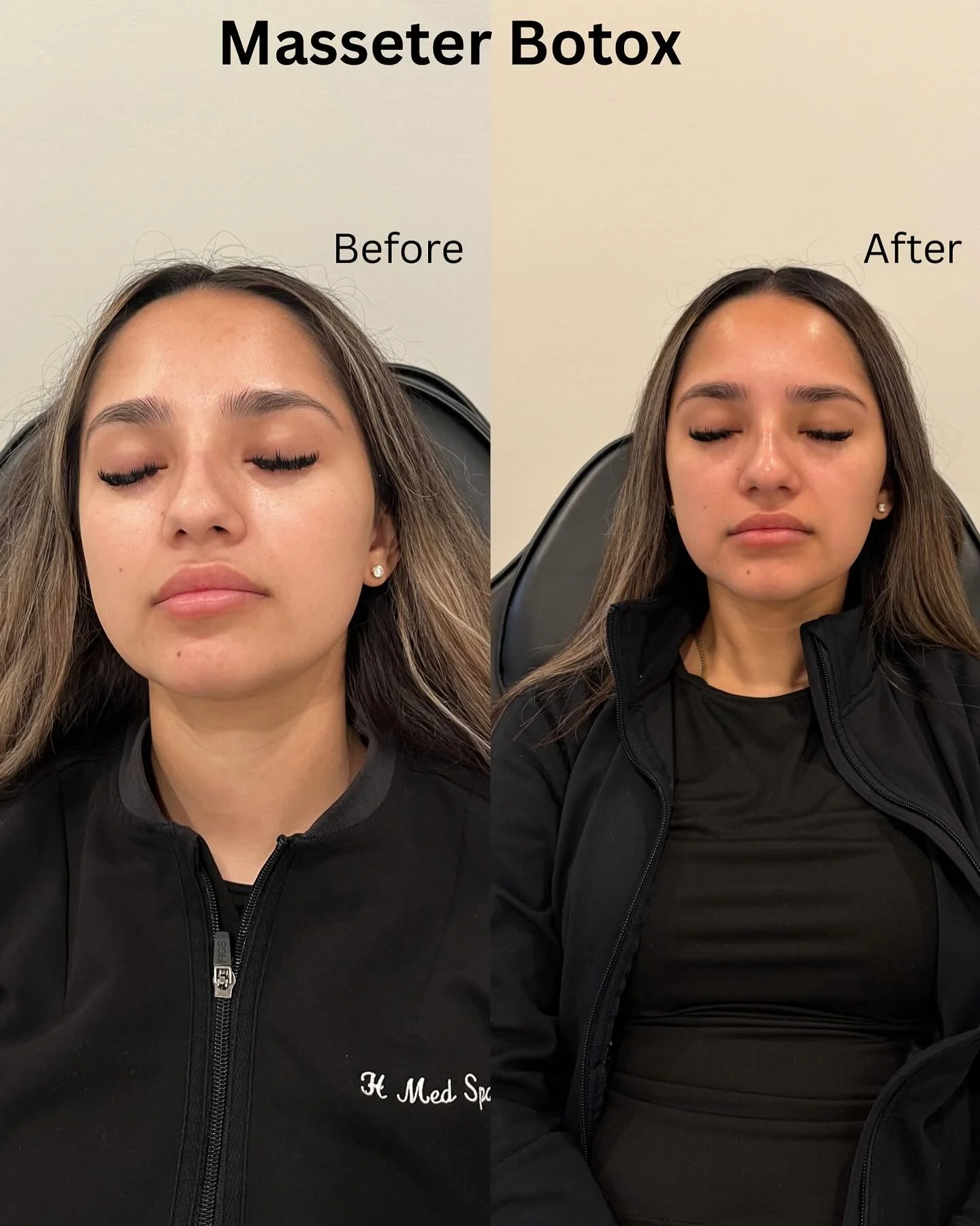 Transform your jawline with Masseter Botox 💉 It helps to reduce jaw pain, teeth grinding and TMJ. It also can help to achieve slimmer jaw, more contoured look ✨ 
Call us for details and appointment! ☎️ (773) 697-8316 

#masseterbotox #botox #jaw #tm