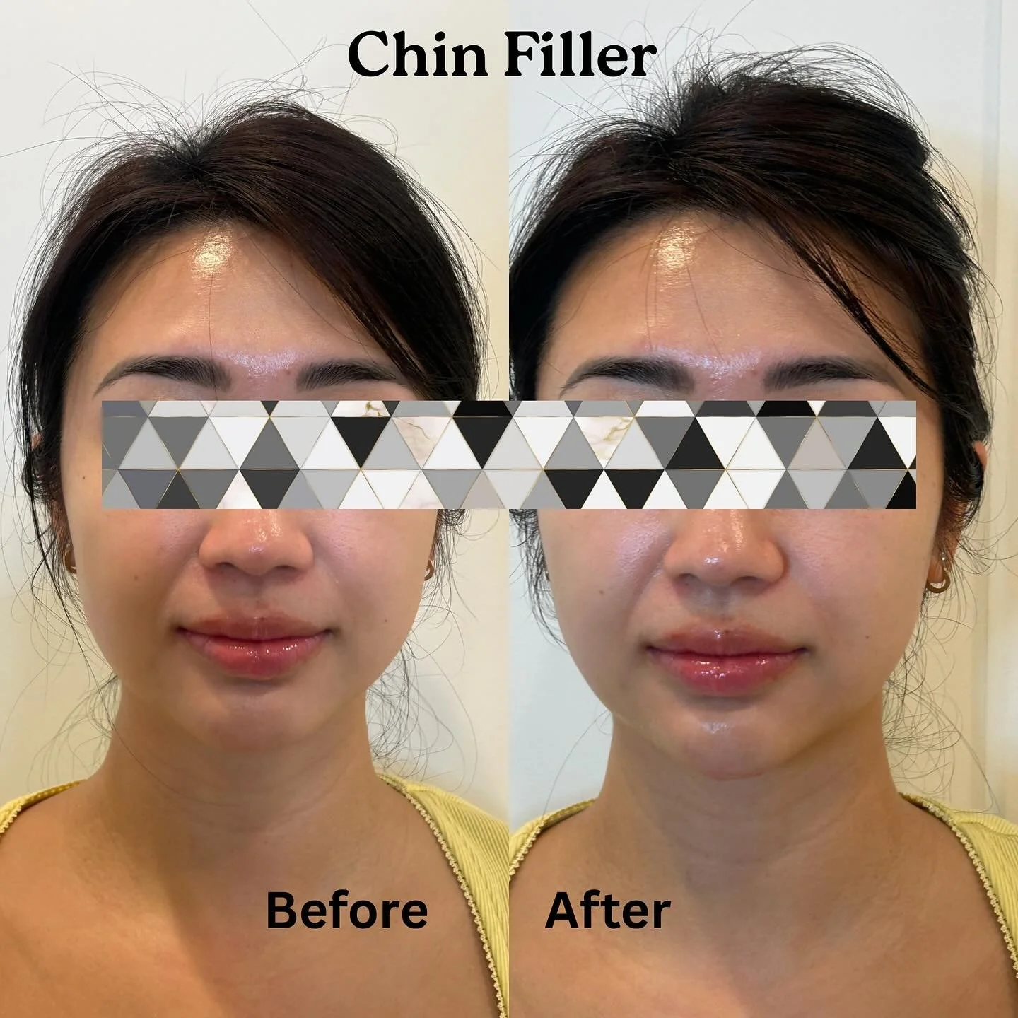 Transform your chin with just a bit of filler 💉 with a more sculpted and contoured jawline. &amp; immediate results! 🧡 

Call us for more info! ☎️ (773) 697-8316 

#chinfiller #chinaugmentation #chin #jawlinecontouring #fillers #medspachicago #hmed