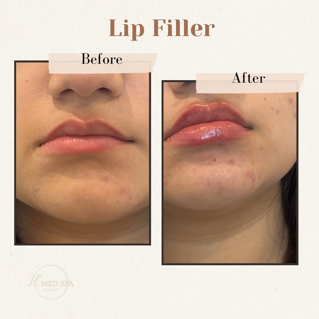 Spring mood with obsessed lip filler 👄 one syringe 💉used on this patient 🧡

Call us to book your appointment! 

#LipFiller #lipplump #lips #beforeandafterphoto #lipfillerchicago #selfconfidence #lookingamazing #feelgreat #medspachicago #hmedspa