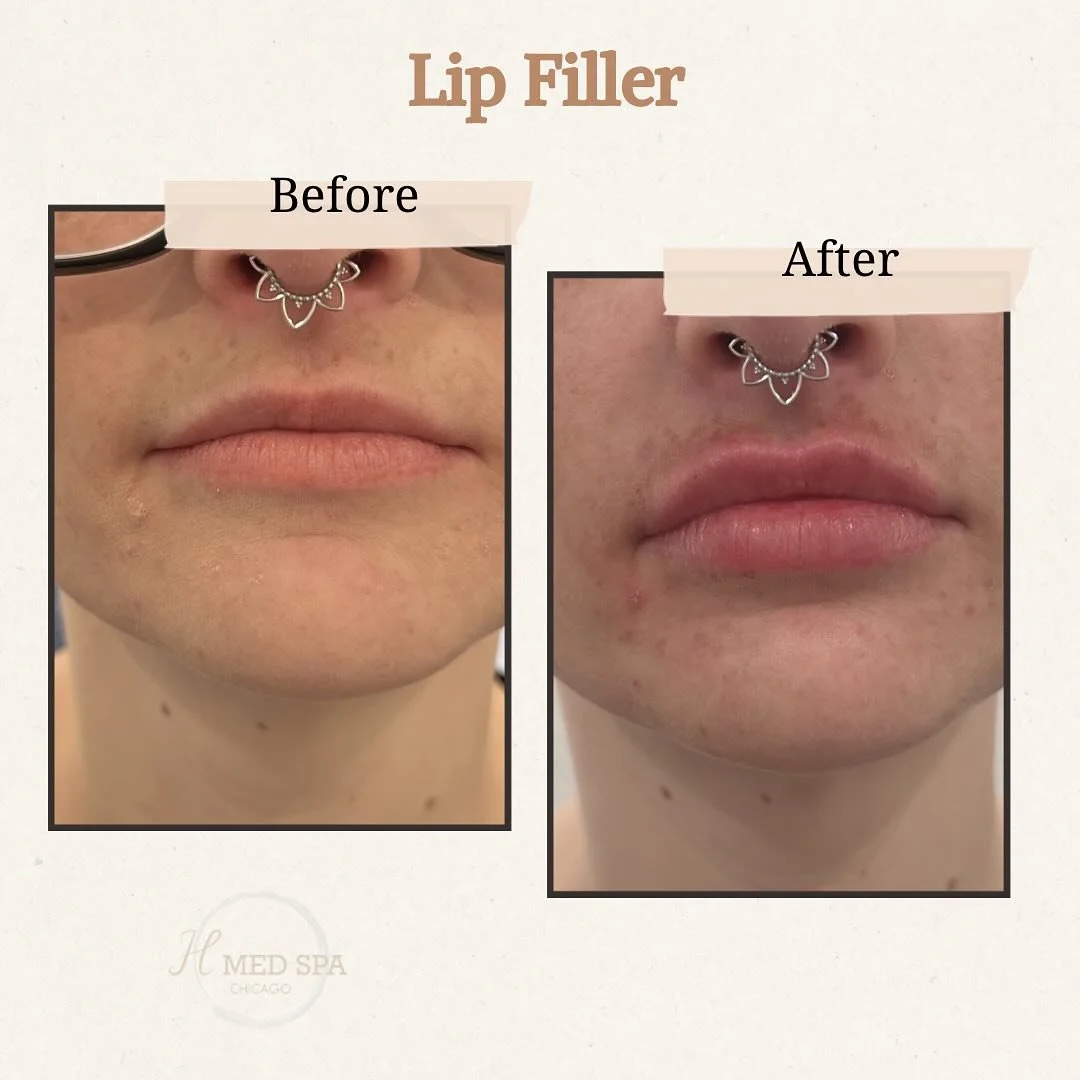 Magic transformation💋 one syringe of volbella used 💉

#lipfillerchicago #lipfiller #beforeandafter #medspachicago #summerlips #fillers #hmedspa #wickerpark