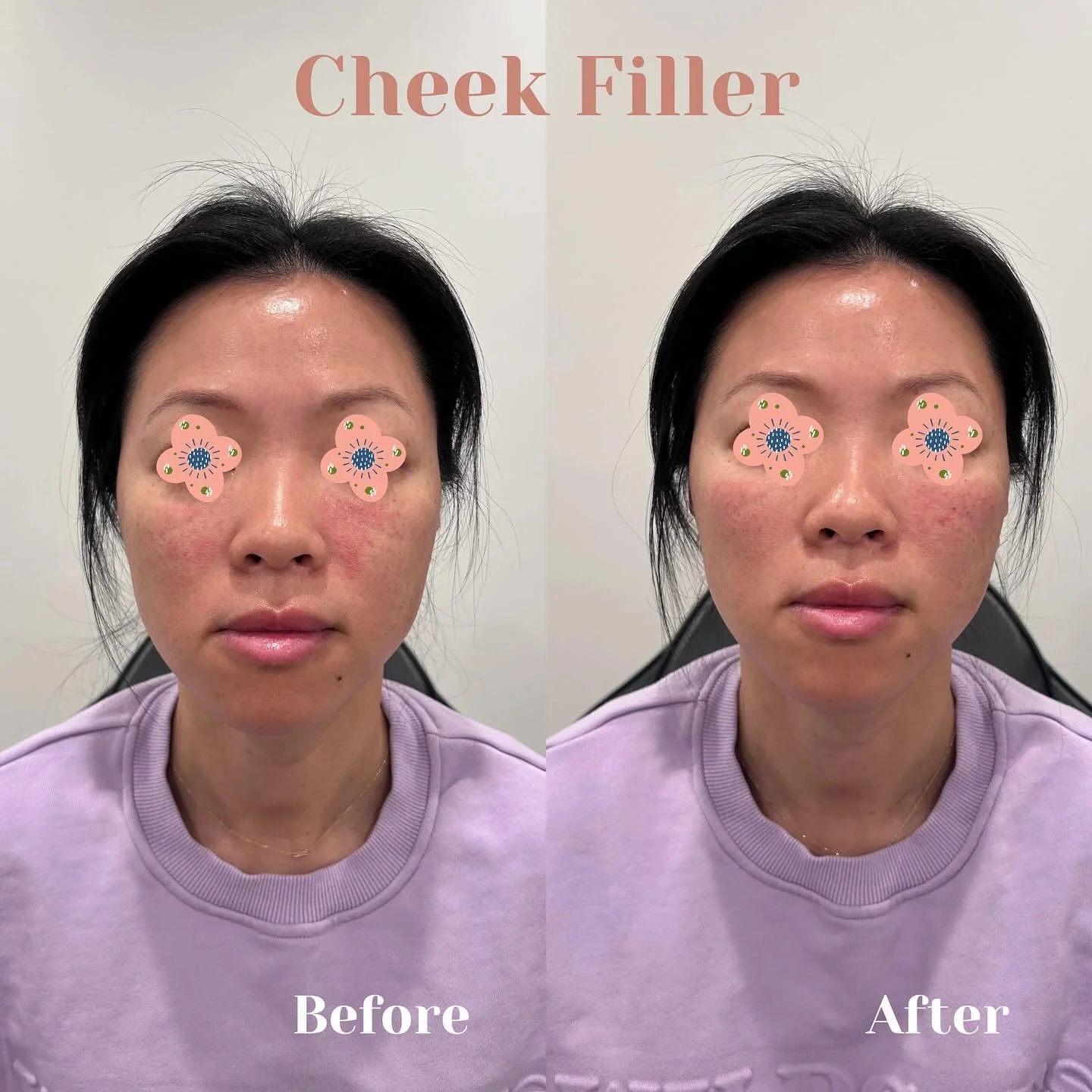 1 syringe 💉 of Voluma used on the cheeks. It gives the natural and plump look for volume and collagen loss. Immediately results. Minimal downtime. 

Call us if you&rsquo;d like to schedule an appointment! ☎️ (773) 697-8316 

#filler #cheekfiller #an