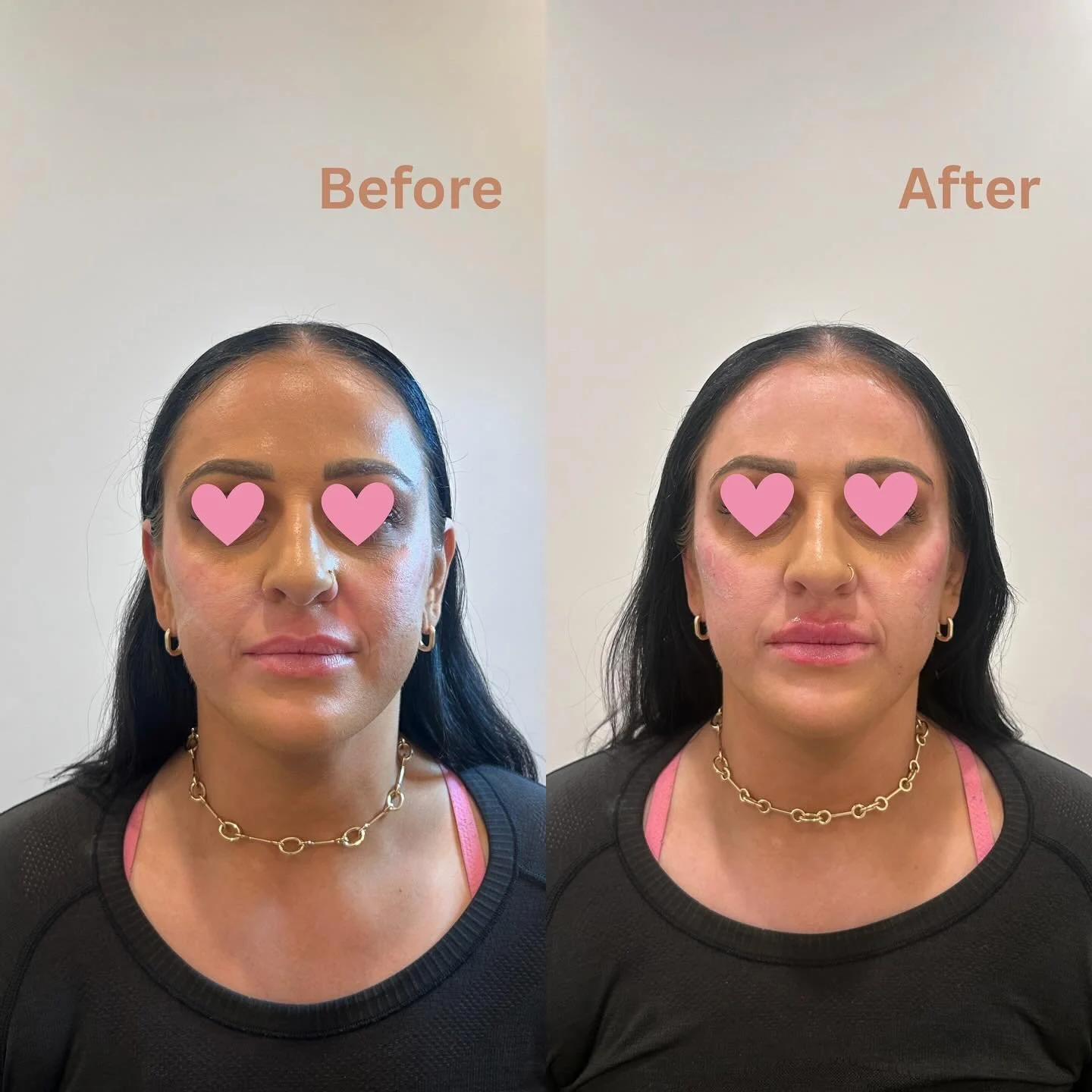 1 syringe of cheek filler used 💉 and with a little bit lip filler touch up 💋💖 

#filler #lipfiller #cheekfiller #chicagomedspa #beforeandafterphoto #mayspecials #mothersday2026 #selfimprovement #selfconfidence