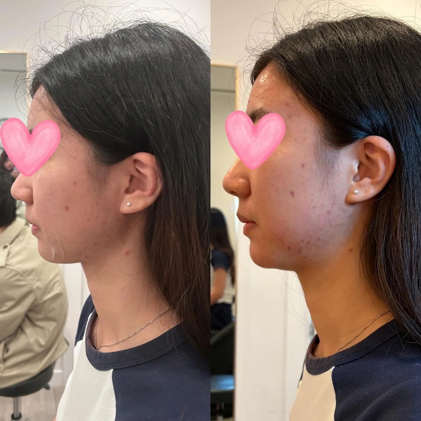 A little bit touch up on the chin makes the jawline a new look. Contoured and smooth ✨ 

#chinfiller #chinaugmentation #chinfillerchicago #jawlinecontouring #medspachicago #selfcare #hmedspa