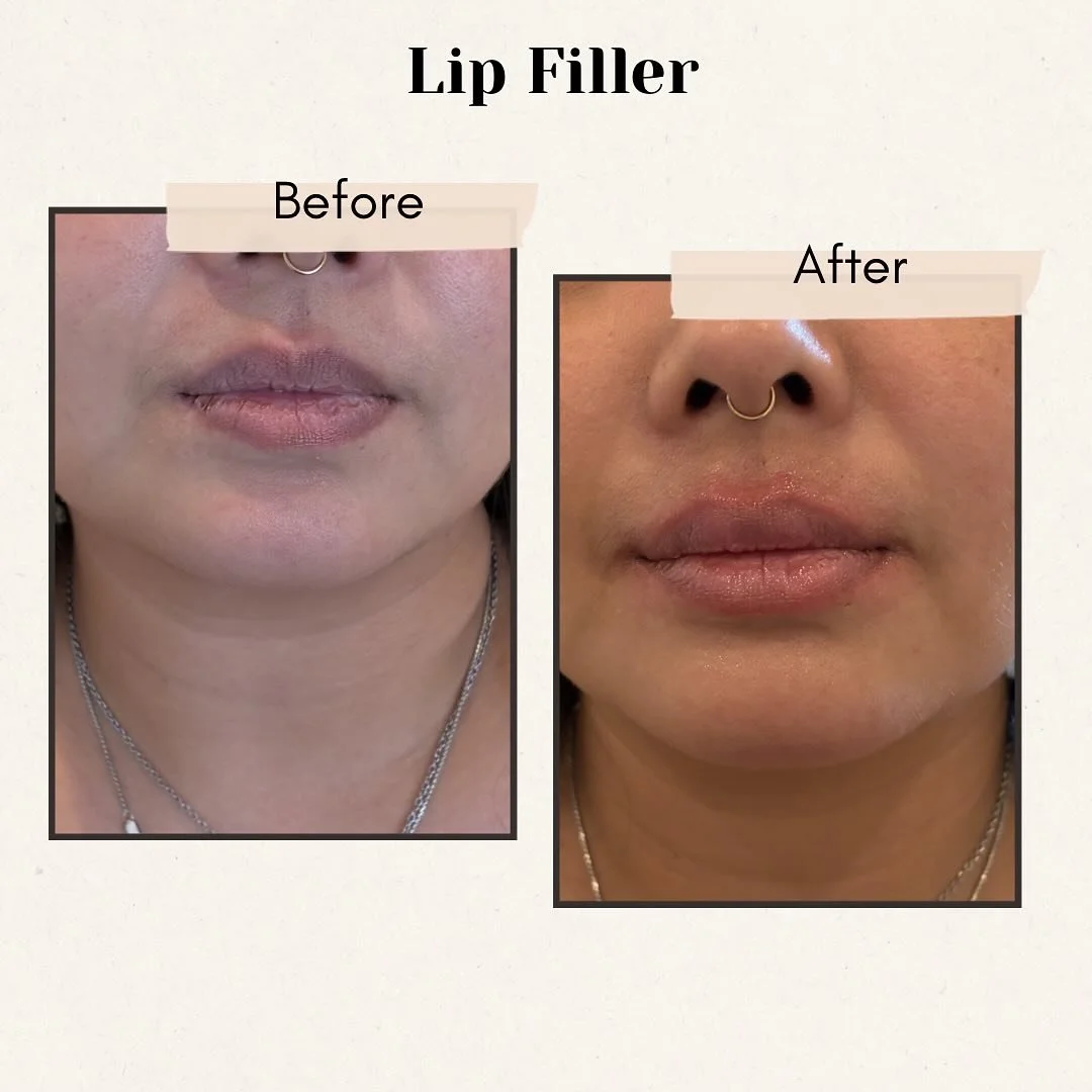 A little bit touch up on the lips to make it fuller and natural look 💉✨ call us if you&rsquo;d like to schedule an appointment 📲 (773) 697-8316 

#lipfiller #lipfillerchicago #medspachicago #beforeandafterphotos #fillerchicago #wickerpark #chicagos