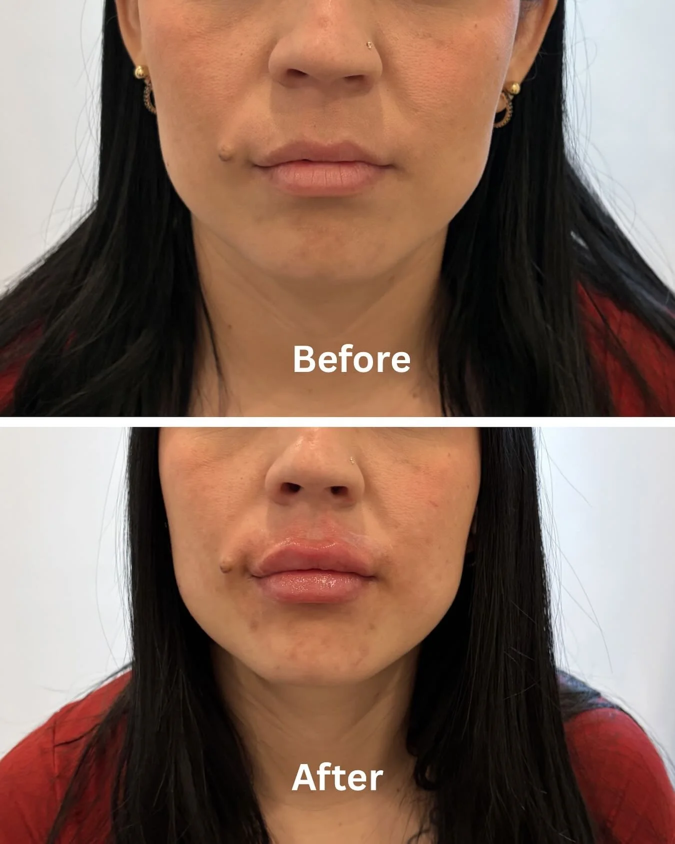Obsessed with the new summer lips 💋💃

#lipfiller #favoritetreatment #summerlook #medspachicago #wellness #chicagospa #lipfillerchicago #rn