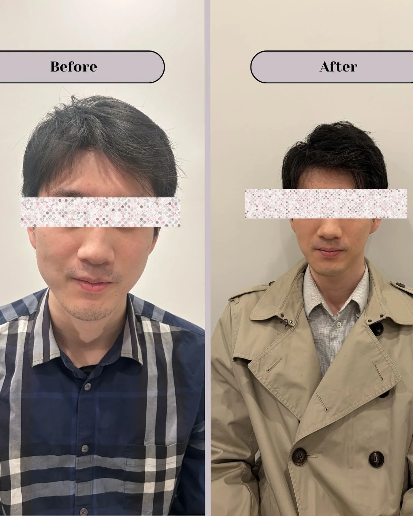 Slimmer and contoured jawline with Masseter Botox 💉 obsessed with the new look! 

#masseterbotox #tmj #jawline #botox #medspachicago #newlook #aestheticinjector #wickerparkchicago