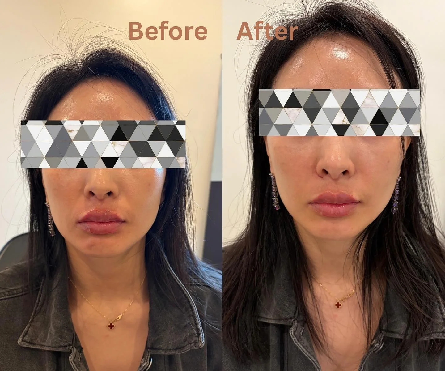 Nasolabial fold filler, also called smile lines. This patient had half of syringe filler done 💉 immediately smoother, visible plump and lifted look. Quick procedure, and will last 10-12 months! 

Call us to schedule an appointment 
☎️ (773) 697-8316