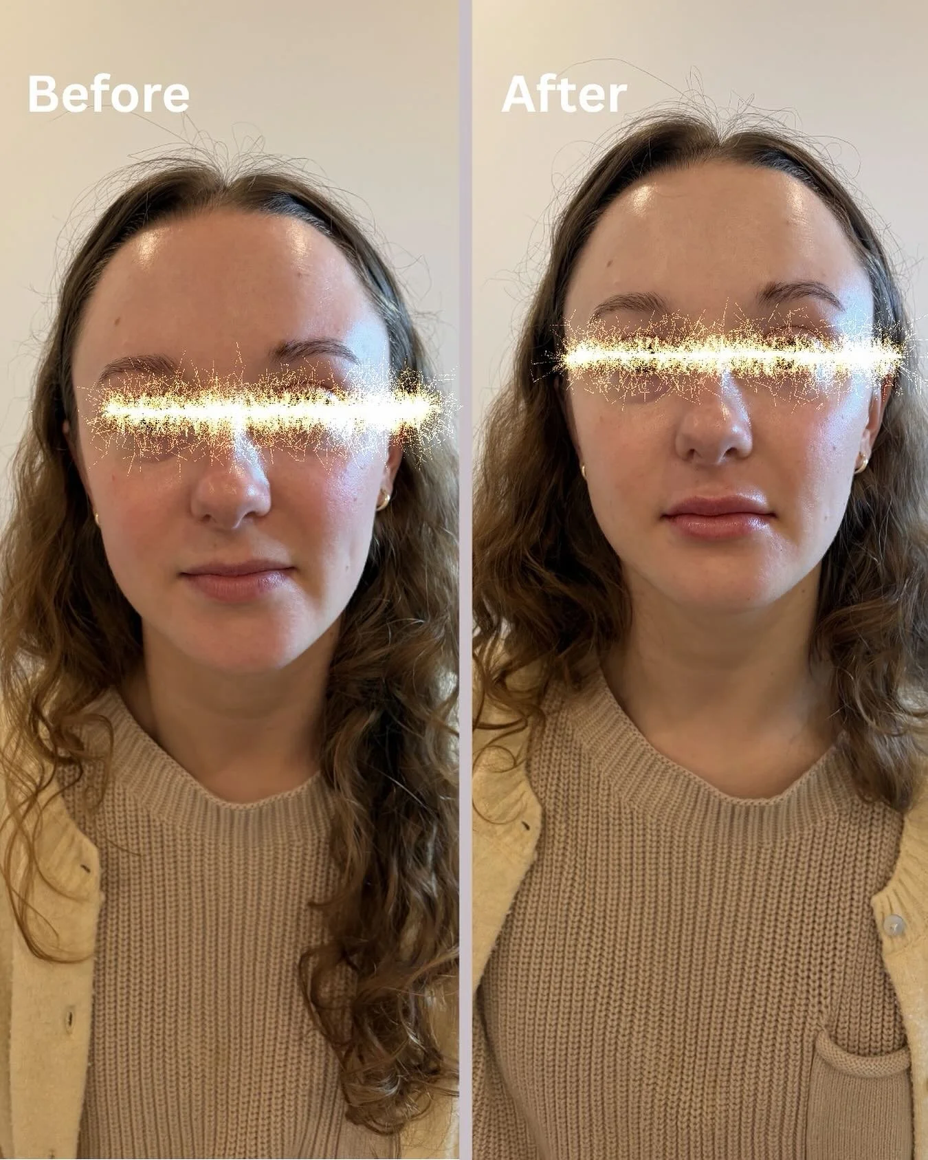 Obsessed with the new lip 💋 New look still yourself. 🌈

Call to schedule an appointment! ☎️ (773) 697-8316

#lipfiller #lipfillerbeforeandafter #lipfillerchicago #lipenhancement #medspachicago #rninjector #wickerparkmedspa #chicagosummer #summerloo