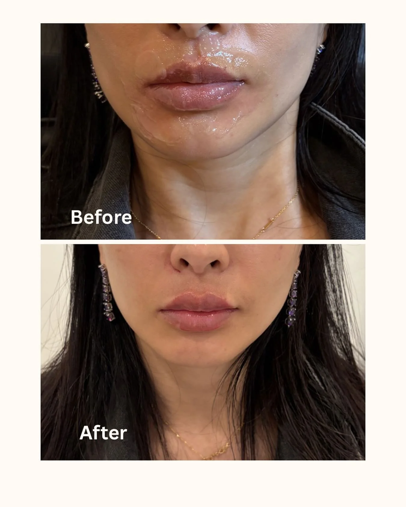 Just a bit touch up on the lips 👄 summer look with plumped natural lips 💉✨🦢 

#Lipfiller #SummerLook #newlips #medspachicago #chicagosummer #medspawickerpark #lookbetter #selfconfidence