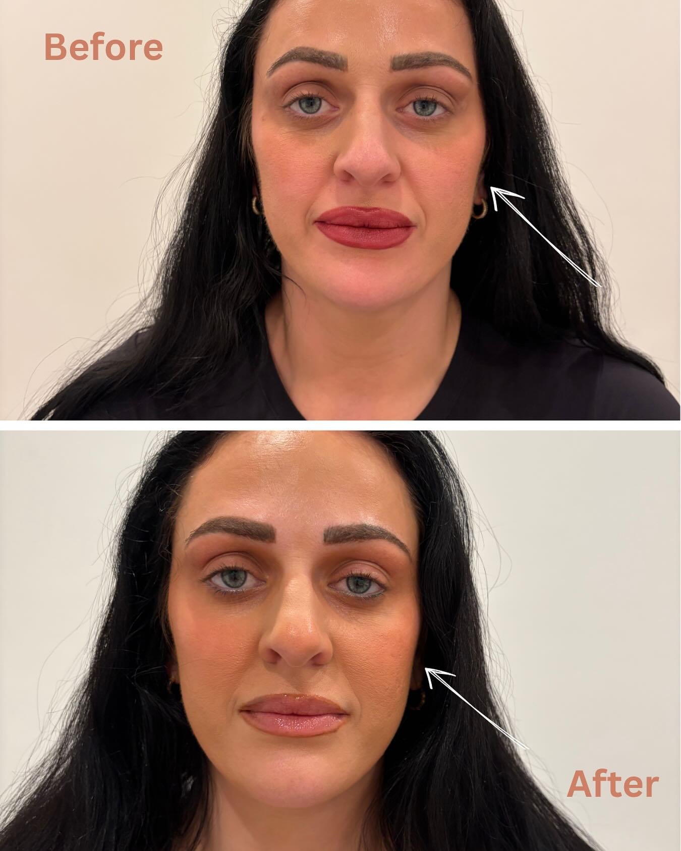 1 syringe 💉 of filler used on the smile lines and cheeks area. Smooth, radiant and youthful look with immediately result 🩵

#nasolabialfolds #nasolabialfiller #smilelines #cheekfiller #youthfullook #medspachicago #wickerparkchicago #beforeandafter 