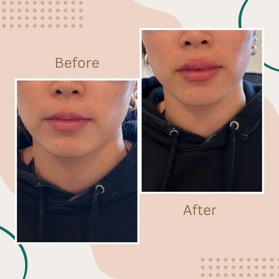 Always favorite treatment all seasons 🌟 Lip filler 💋

#beforeandafterphotos #favoritetreatment #LipFiller #naturallooking #lipfillers #lipfillerchicago #medspachicago #medspawickerpark #summervibes #newlook #hmedspa