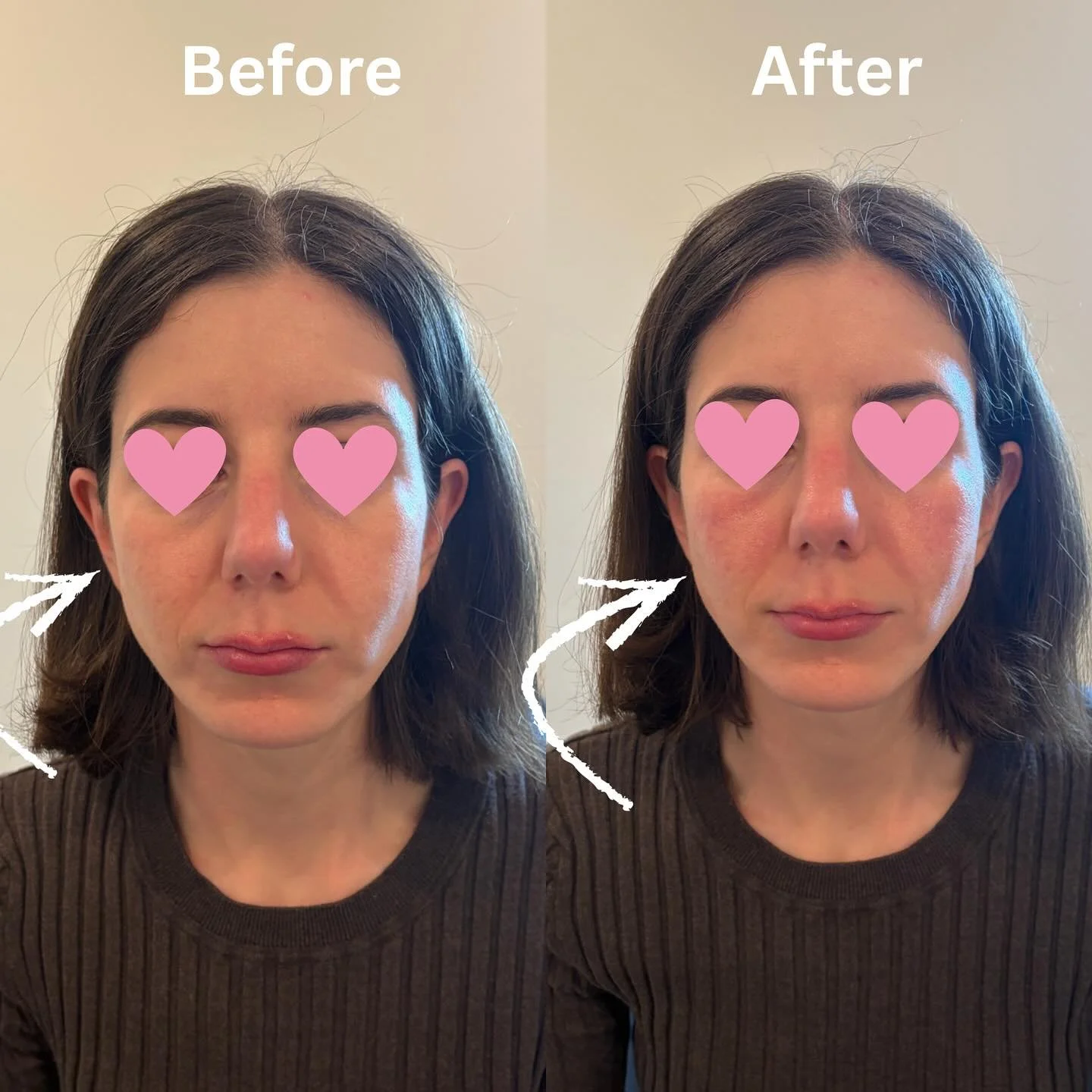 Mid-face rejuvenation💉 With just a little bit of filler touch up for more plump, natural and rejuvenated look✨ 

Call to book an appointment with us! 
📱 (773) 697-8316

#Rejuvenation #Fillers #youthfullook #chicagomedspa #newlook #naturalresults #s