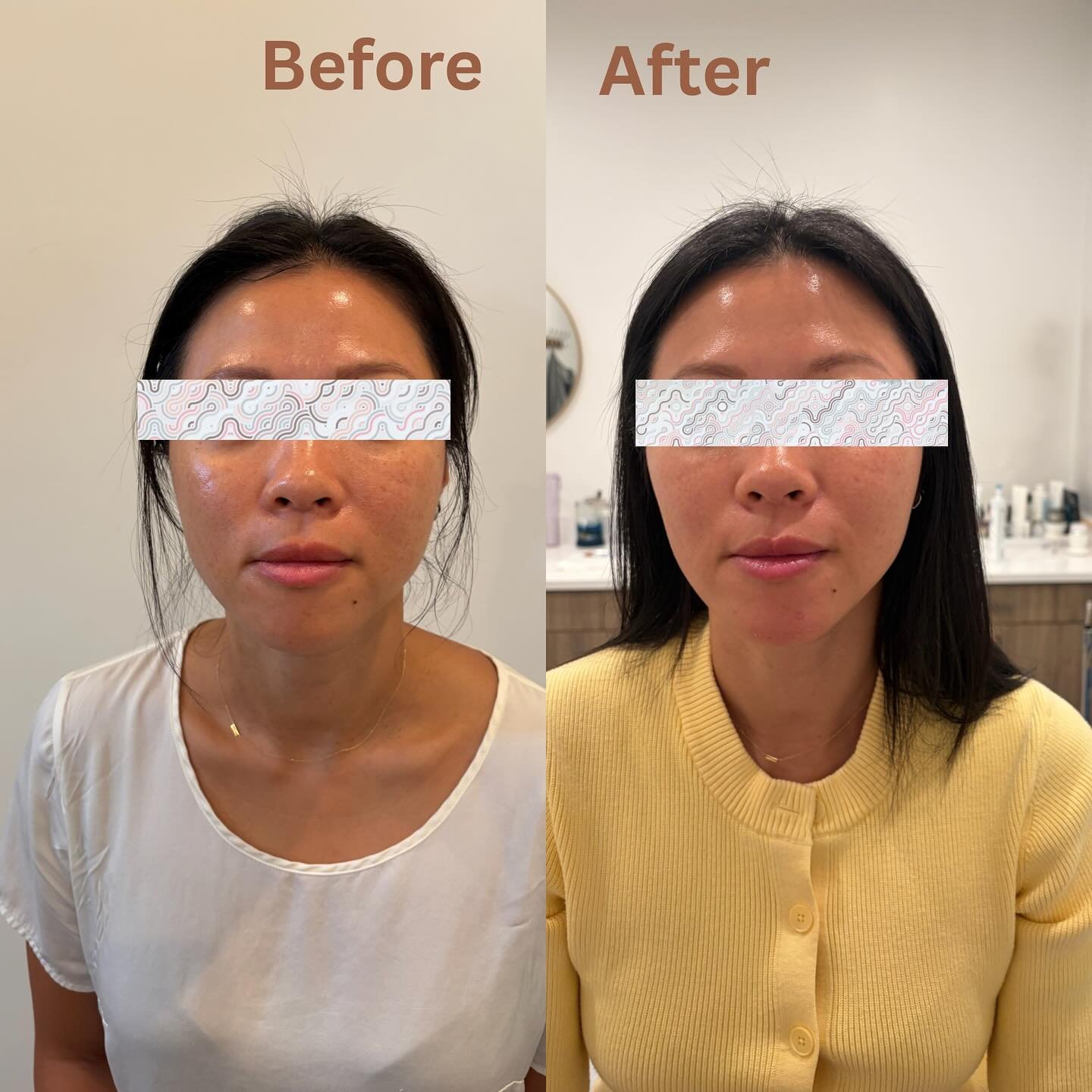 Jawline contour/slim with masseter Botox 💉 
After photo was taken 3 weeks after the treatment! 

#masseterbotox #tmj #jawlinecontouring #jawlineslimming #botoxchicago #lowerfacebalancing #hmedspa #medspachicago #wickerparkmedspa #rninjector