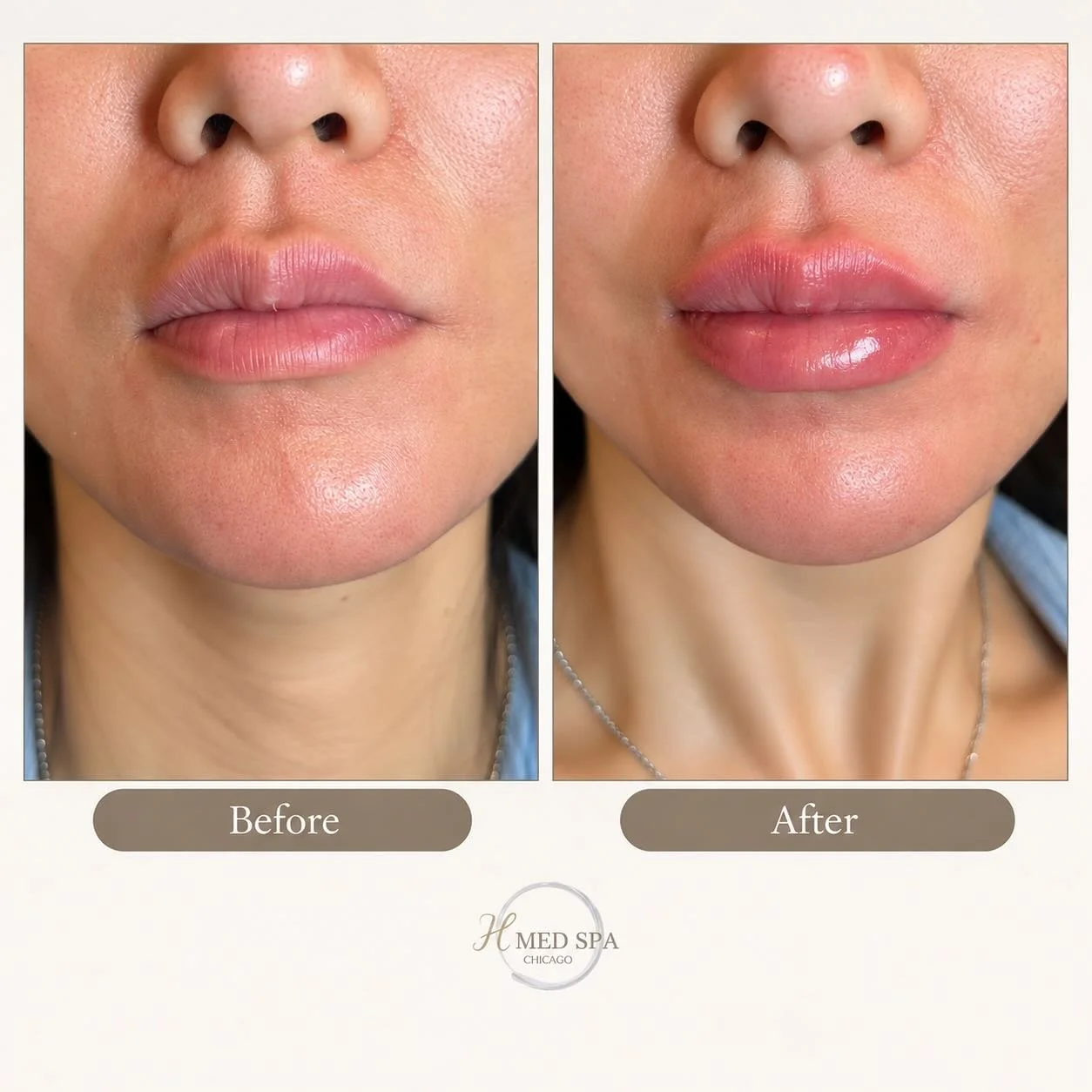 Subtle enhancement. Beautifully balanced. 💋

A touch of added volume and definition to enhance the lips&rsquo; natural shape while maintaining soft, harmonious proportions.

At H Med Spa Chicago, our approach to lip enhancement is personalized, with
