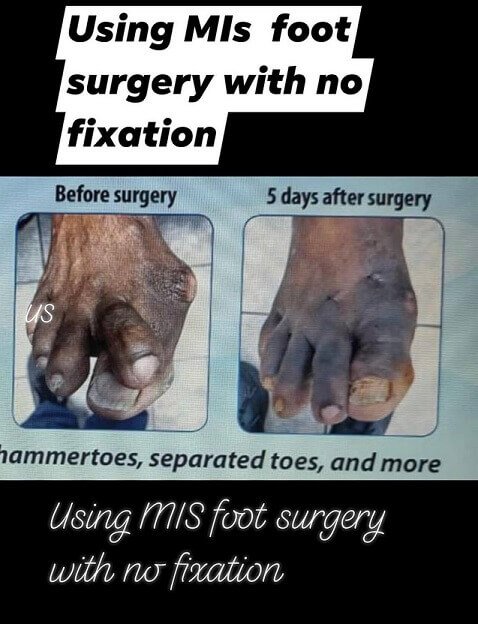 using-mis-foot-surgery-with-no-fixation-dr-ed-cohen.jpg