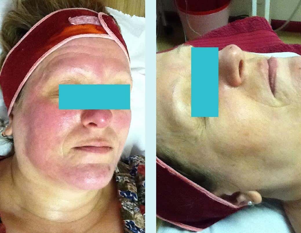 rosacea.jpg