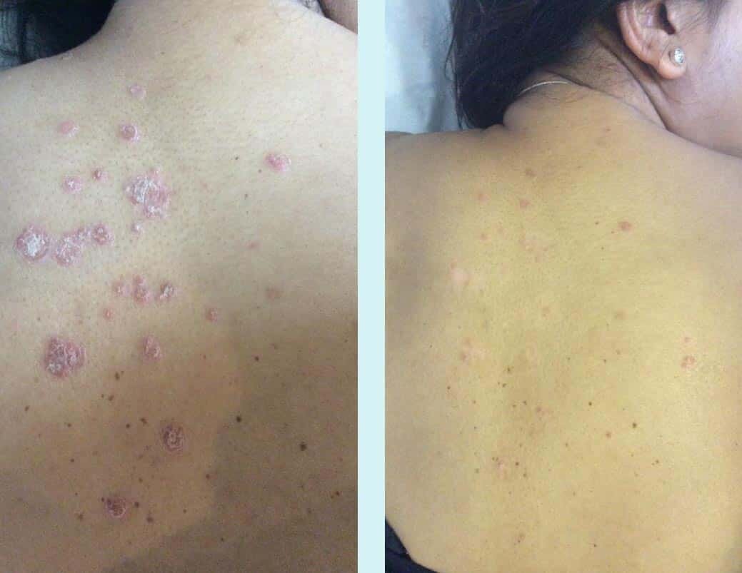 guttate-psoriasis1.jpg